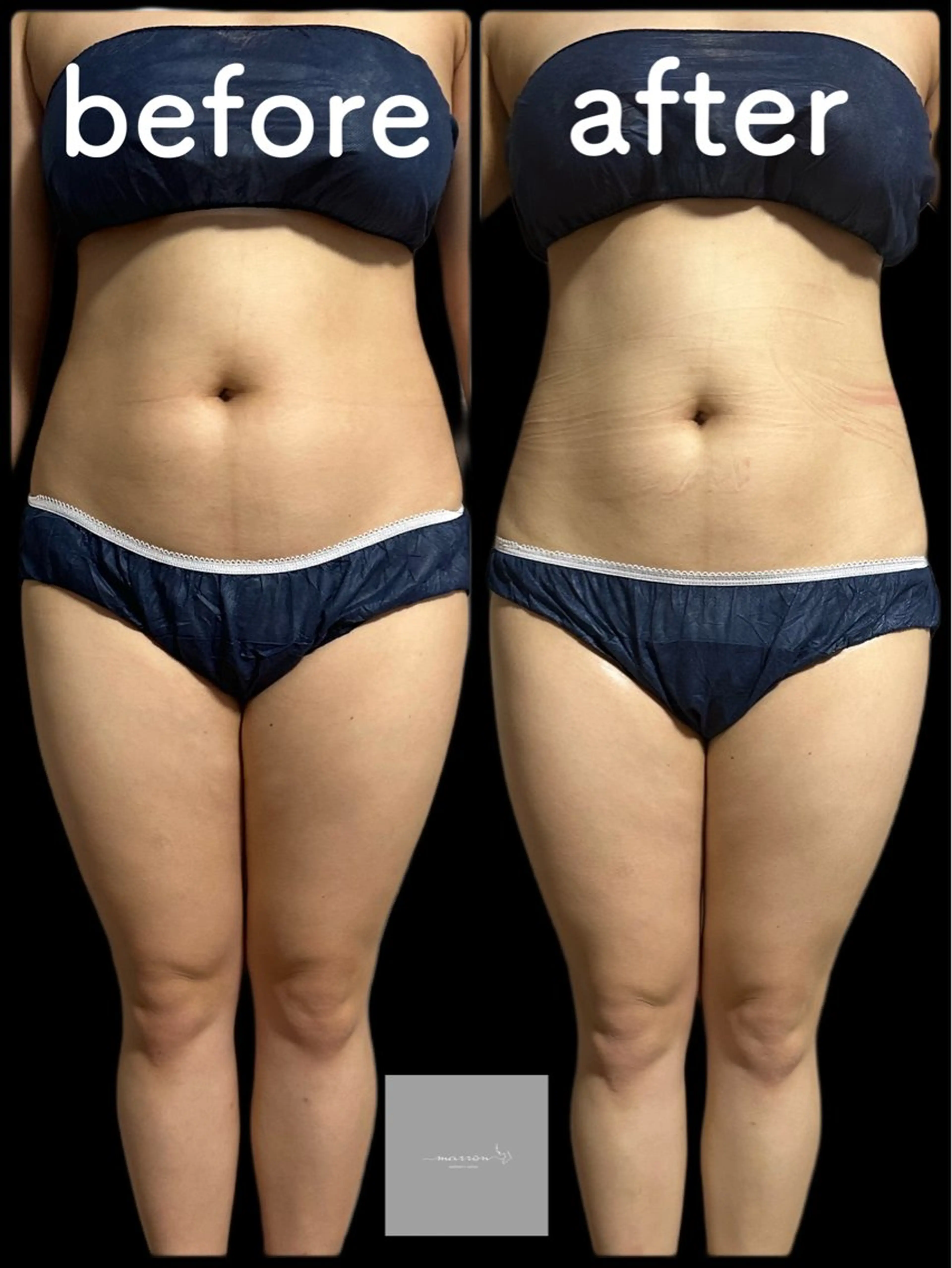 marron所属・痩身ハイパーナイフ ララピールリアボーテのエステ・リラクイメージ