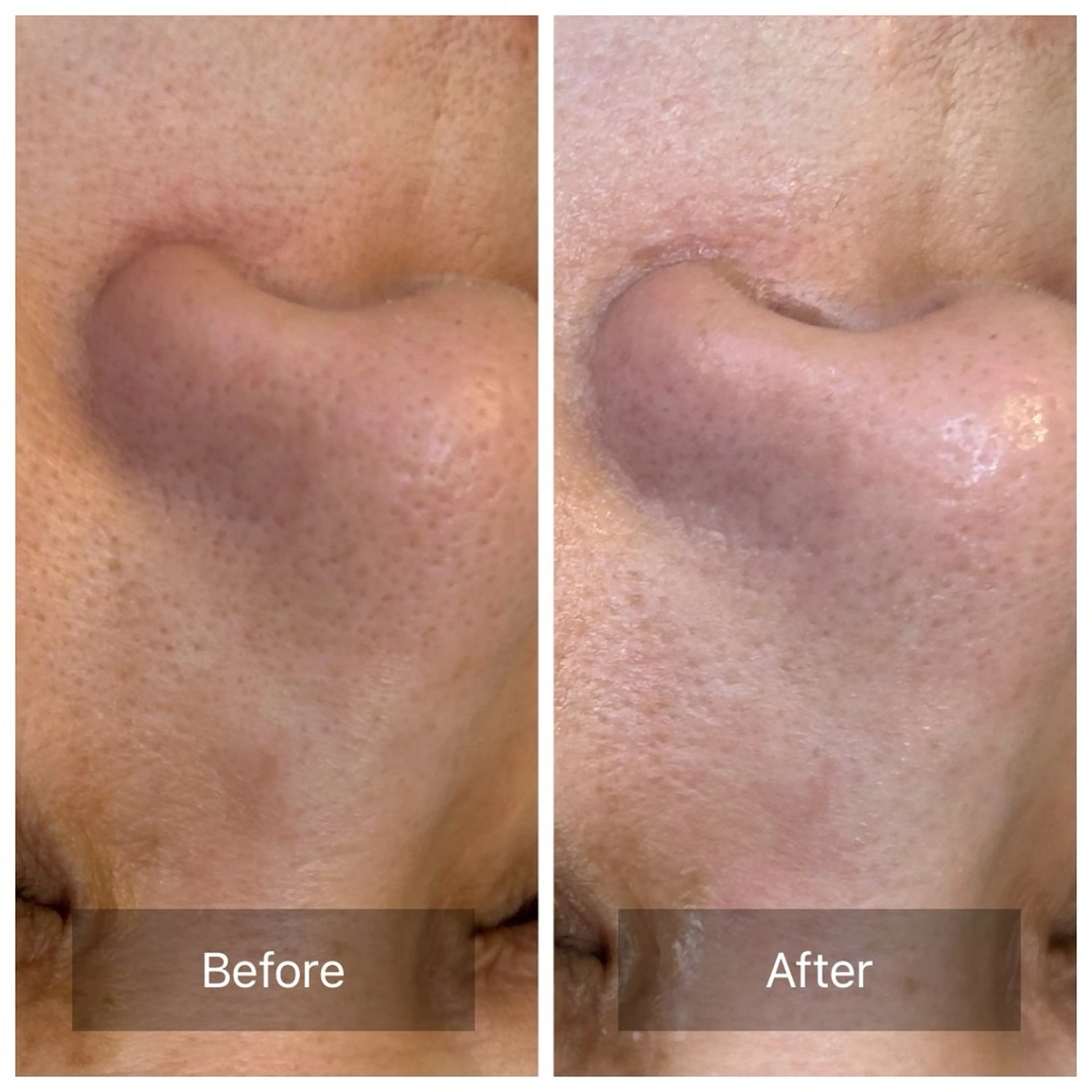 毛穴悩みコース👃【通常9,000円】約90分の写真