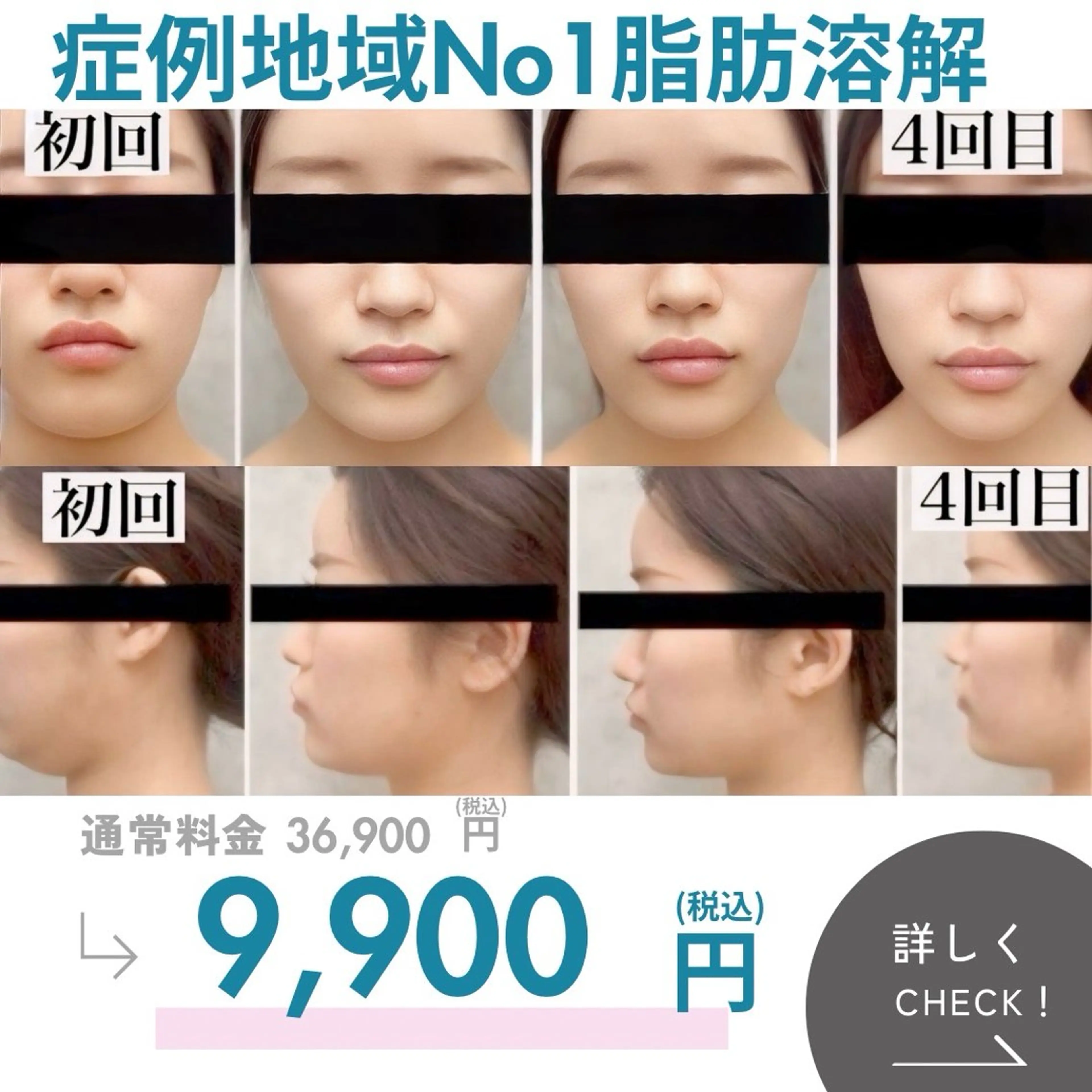 注射なし脂肪|1回でスッキリ小顔実感✨デコルテマッサージ付きの写真