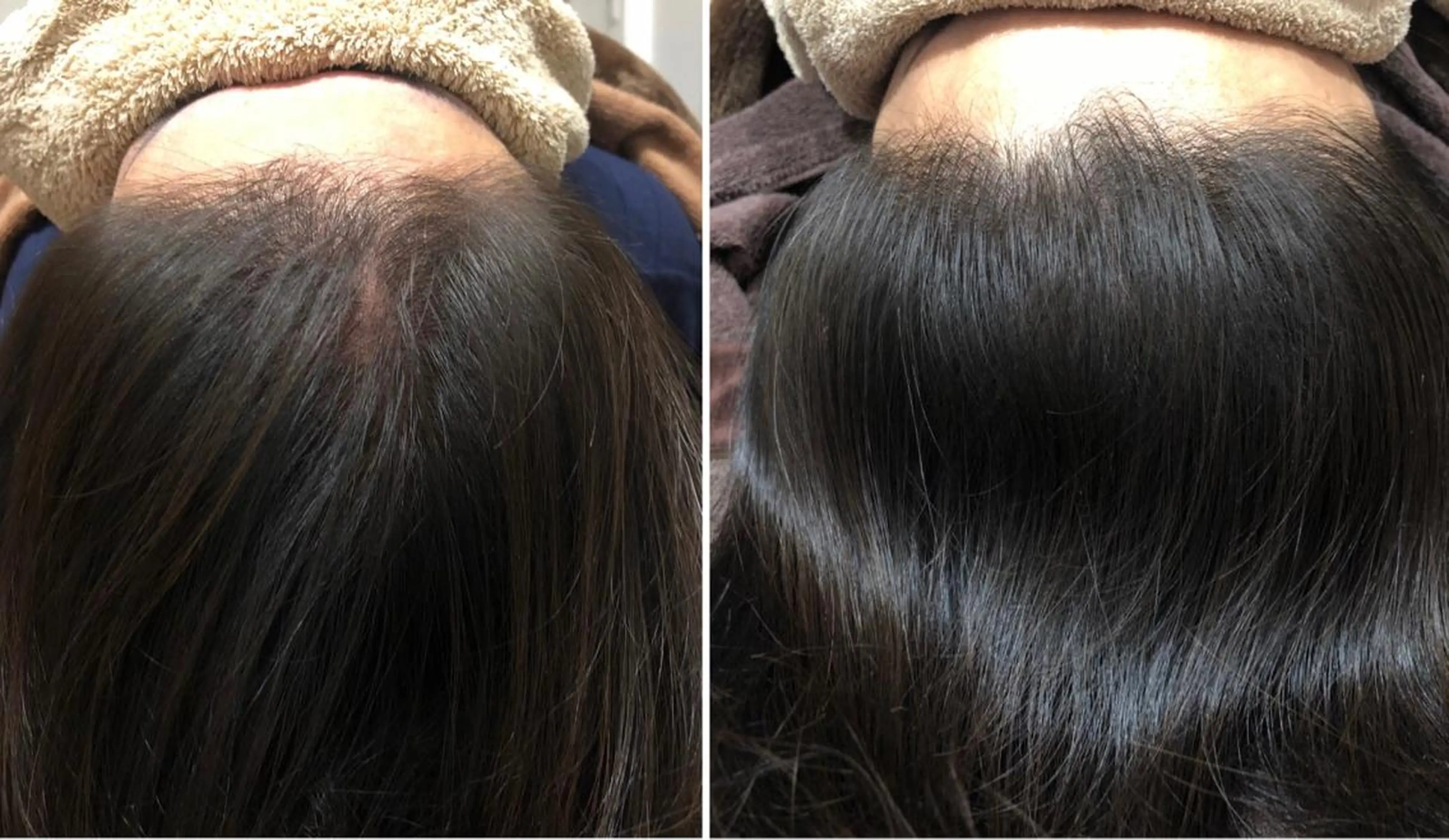 ★特別メニュー★ヘアケアスペシャル頭皮鍼の写真