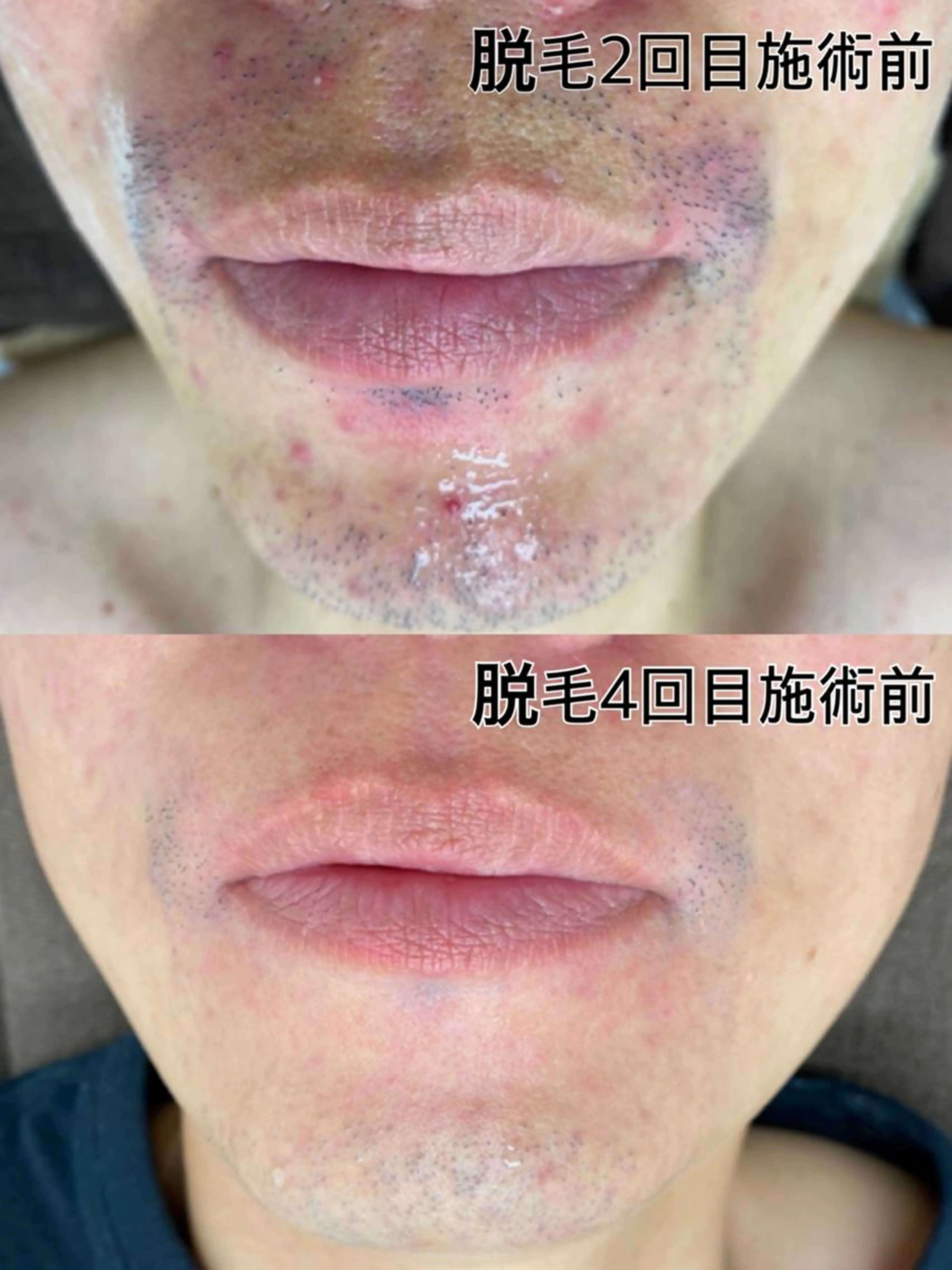 【メンズ高速脱毛】1回¥3.300最近美肌脱毛機で髭脱毛の写真