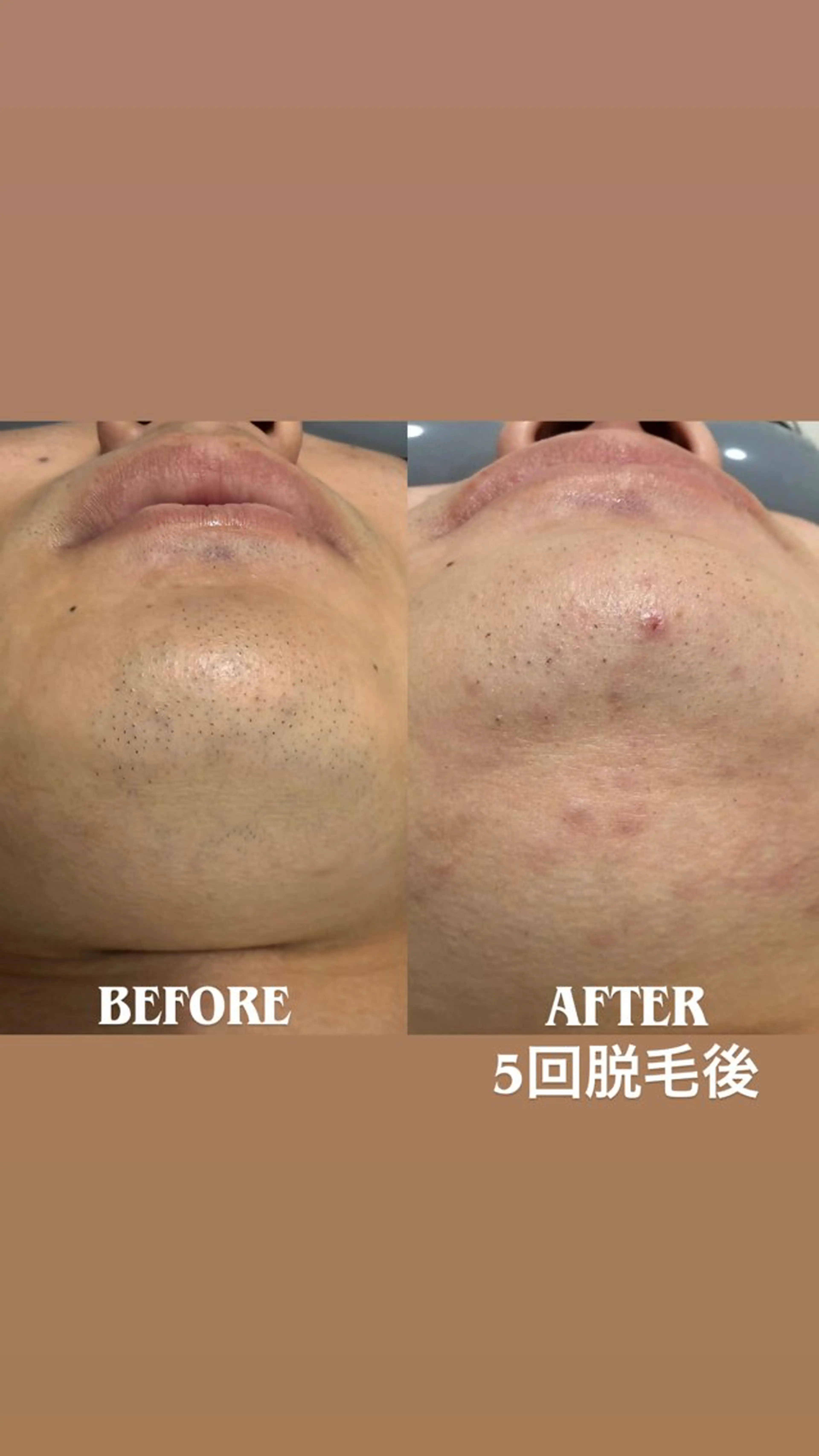 脱毛 More   Beauty所属・More Beautyのエステ・リラクイメージ