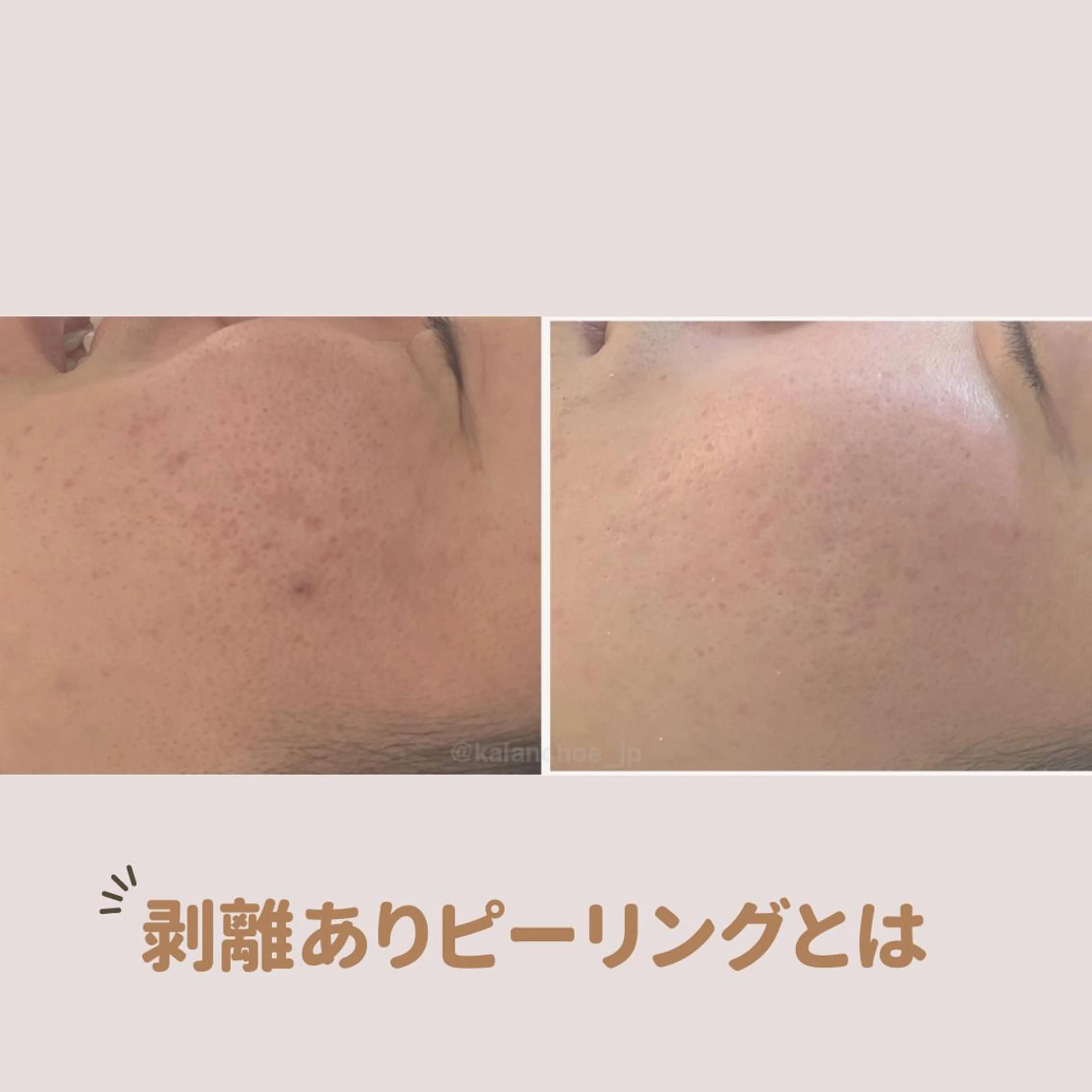 エステ 肌質改善 KALANCHOEのエステ・リラクイメージ