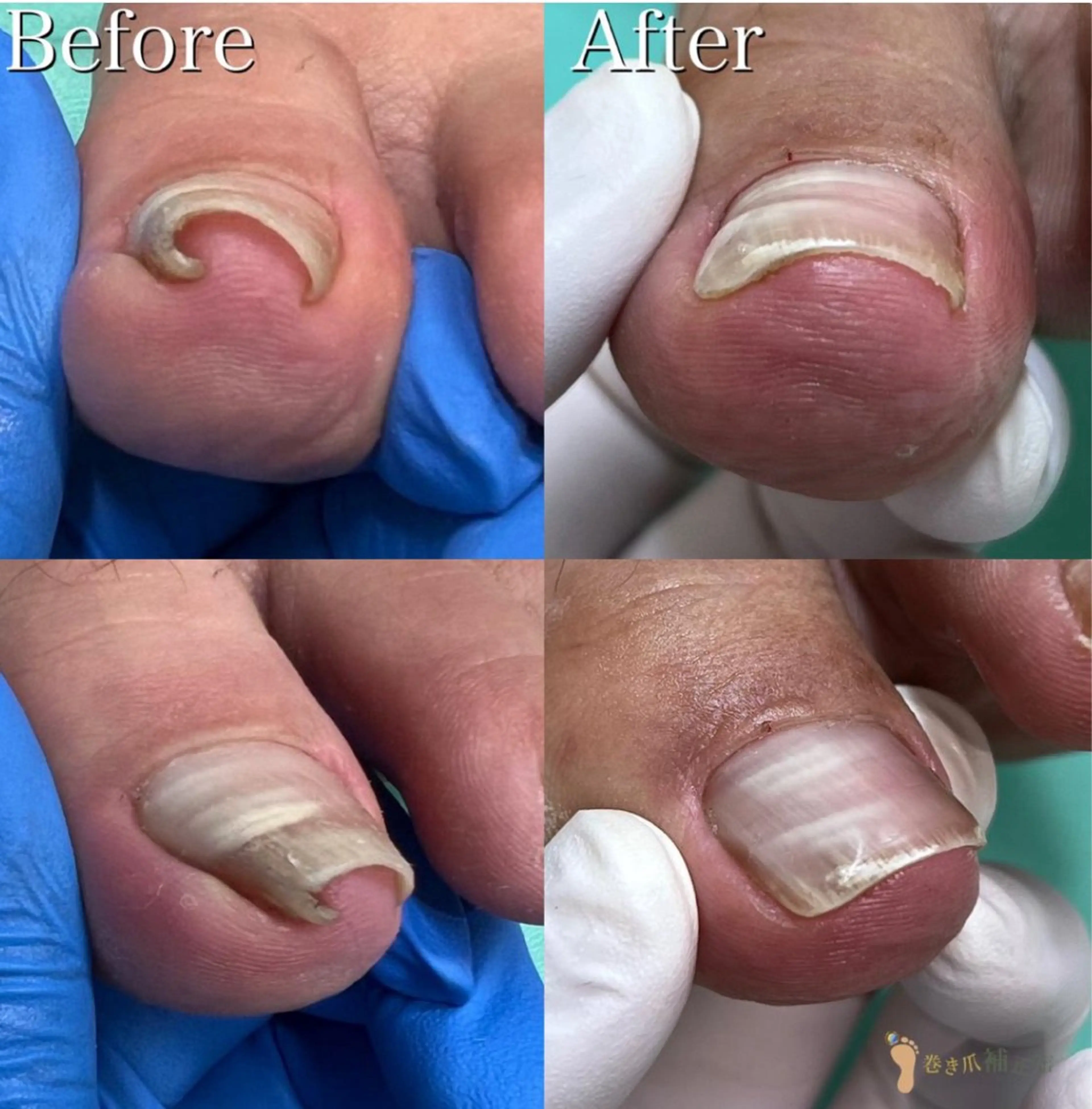 【巻き爪】朗報✨【🉐2回目以降もずっと"施術料が500円🉐】 1爪の巻き爪補正✨痛い💥形が気になる方も💁‍♀️の写真