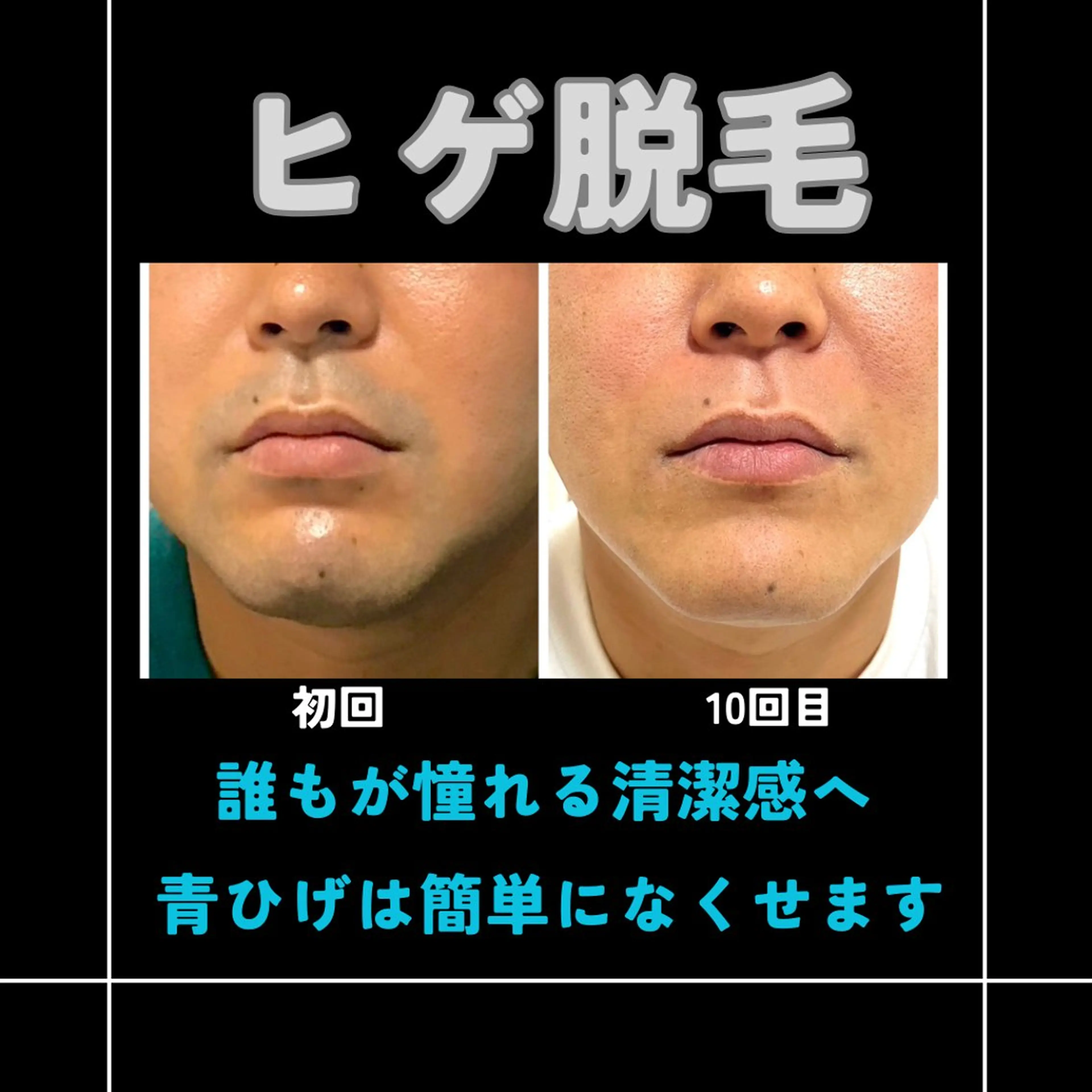 メンズ 1番人気✨抜けると評判👍ハイパワーなのに痛みが少ない脱毛機を使っておりオススメです😊お試し価格でどうぞ✨の写真