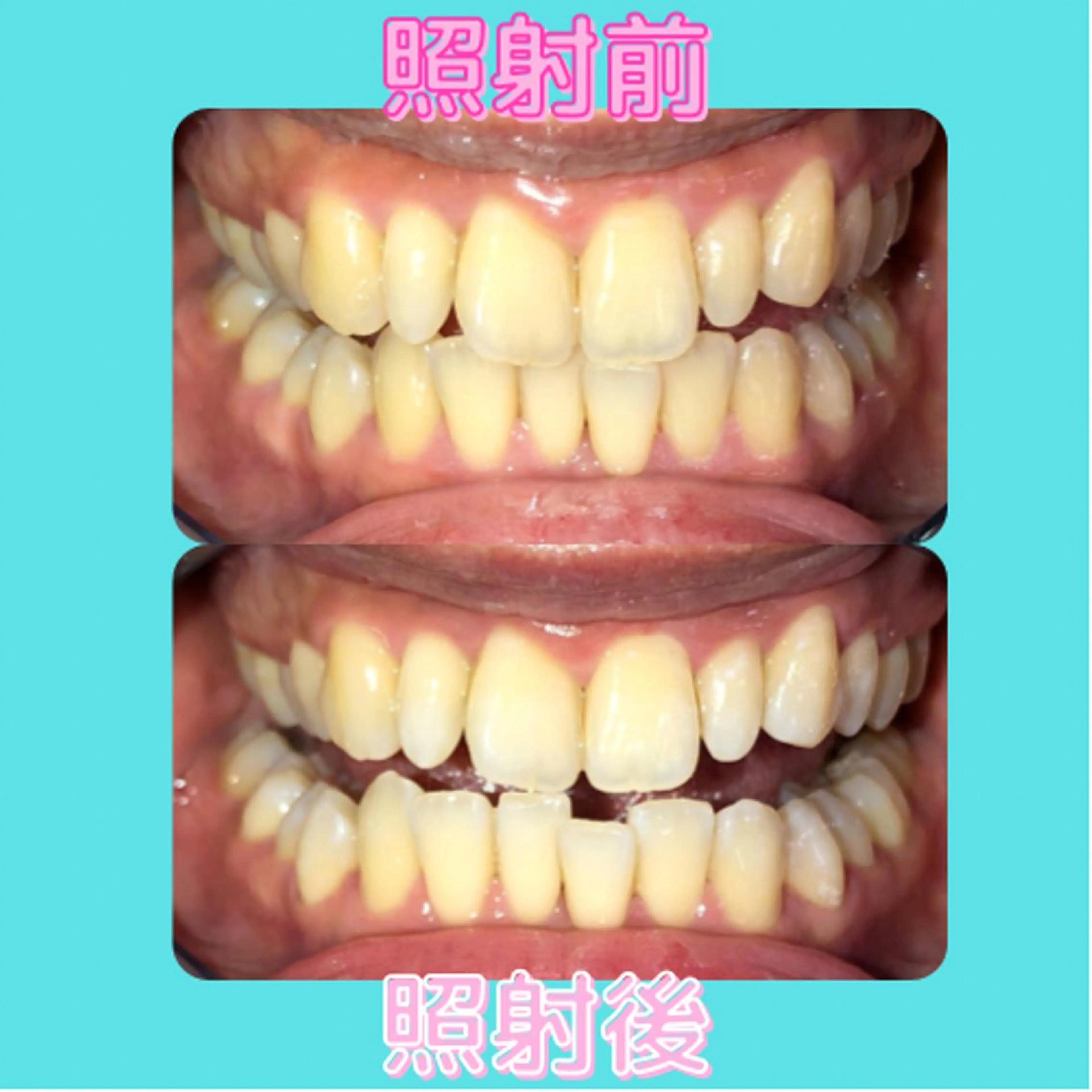 ホワイトニング｜韓国式3D毛穴洗浄 lonhana ﾛﾝﾊﾅ所属・韓国式3D毛穴洗浄 lonhanaのその他イメージ