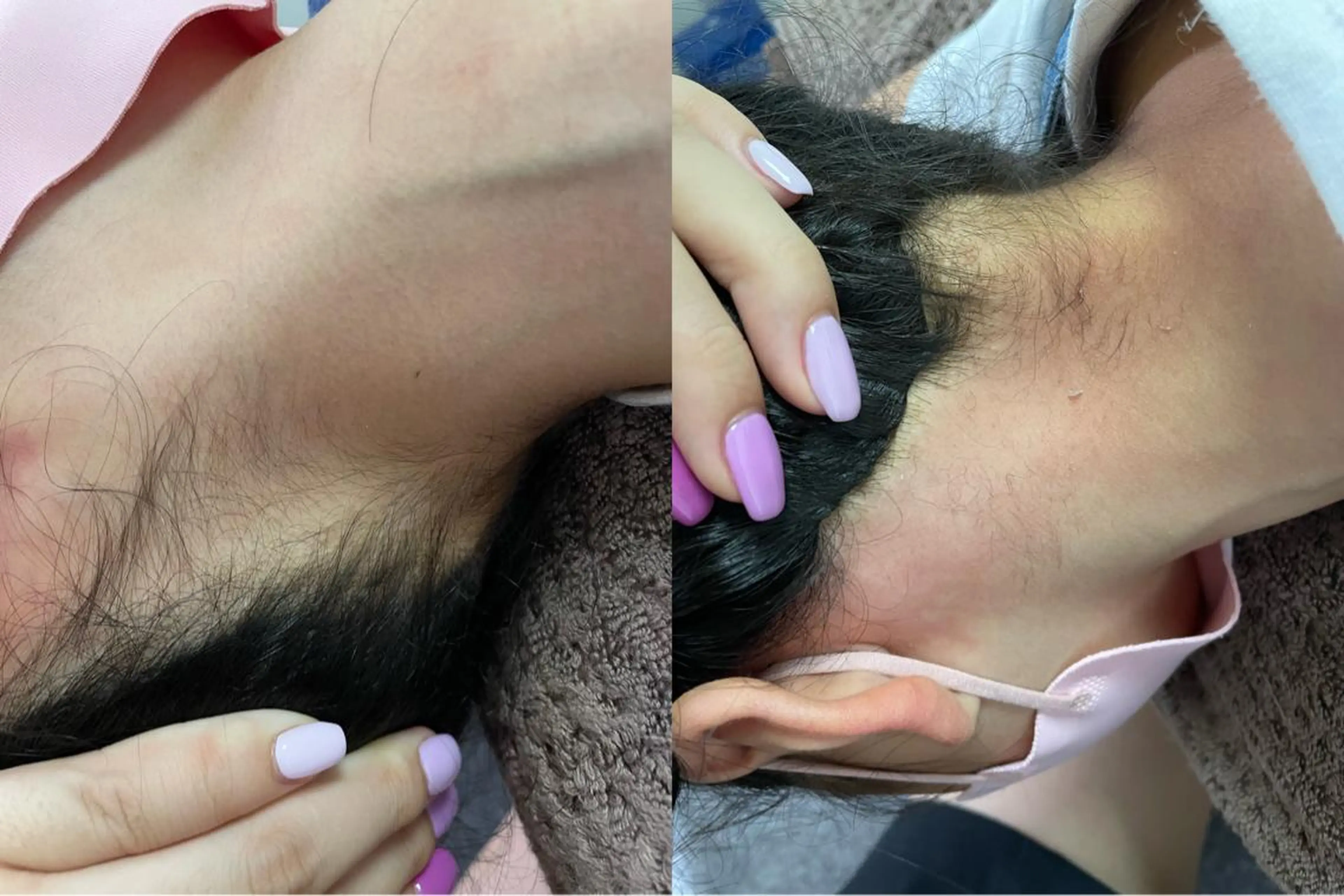 ブラジリアンワックス【襟足】の写真