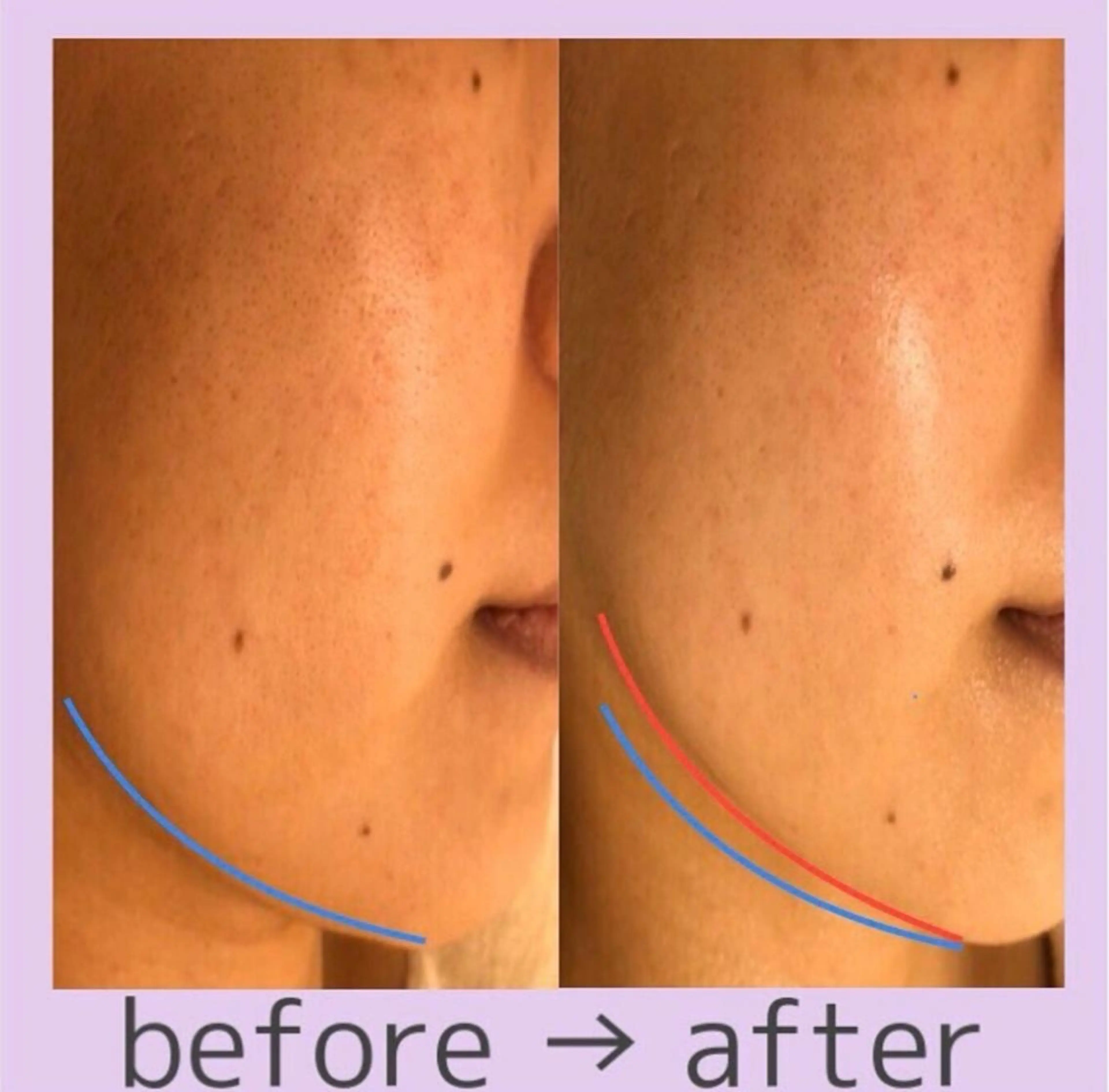 ポーラ心斎橋御堂筋店所属・小顔毛穴/POLA 心斎橋難波5分のその他イメージ