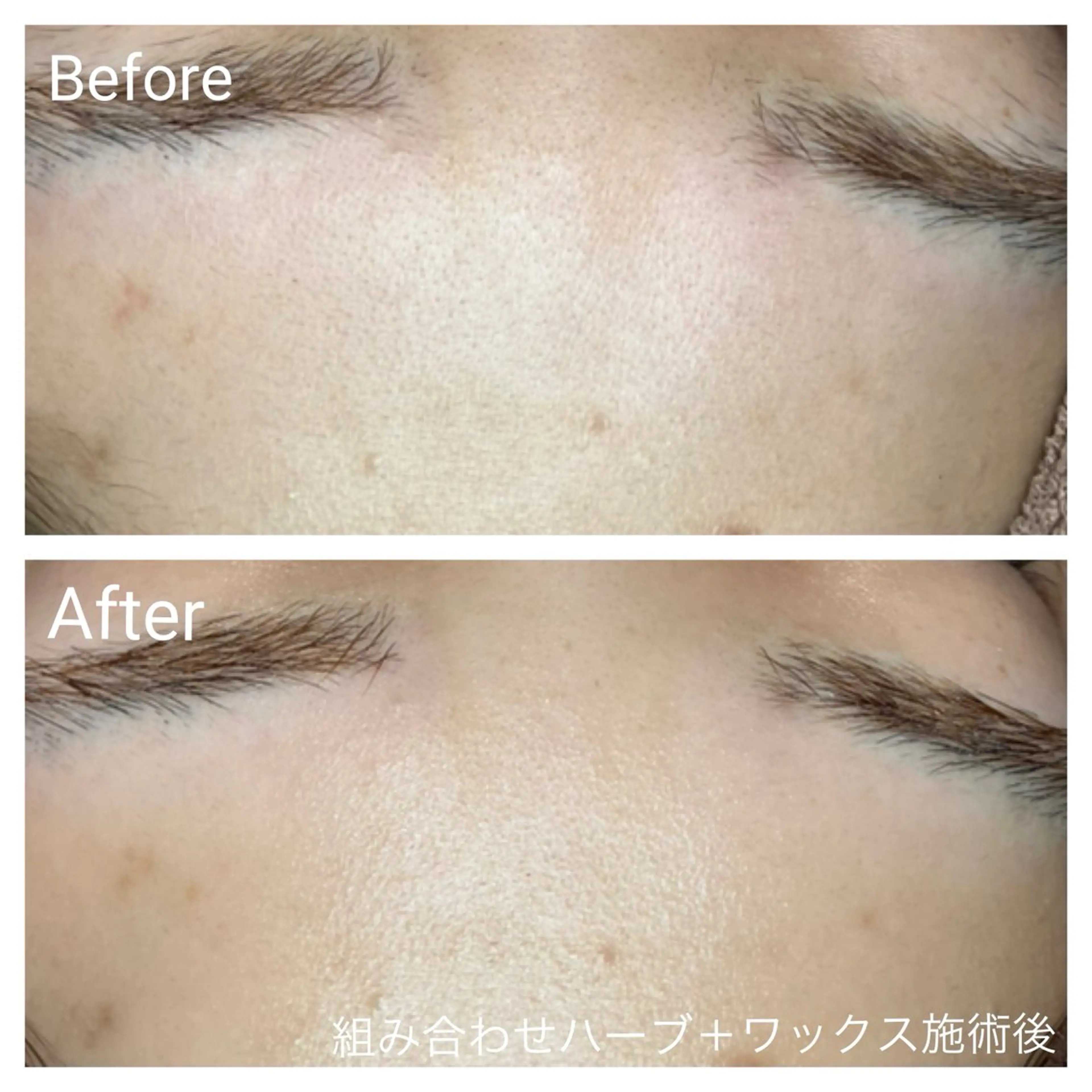 ⭐️お悩み別に施術⭐️肌育ハーブピーリング+フェイスワックス90分の写真