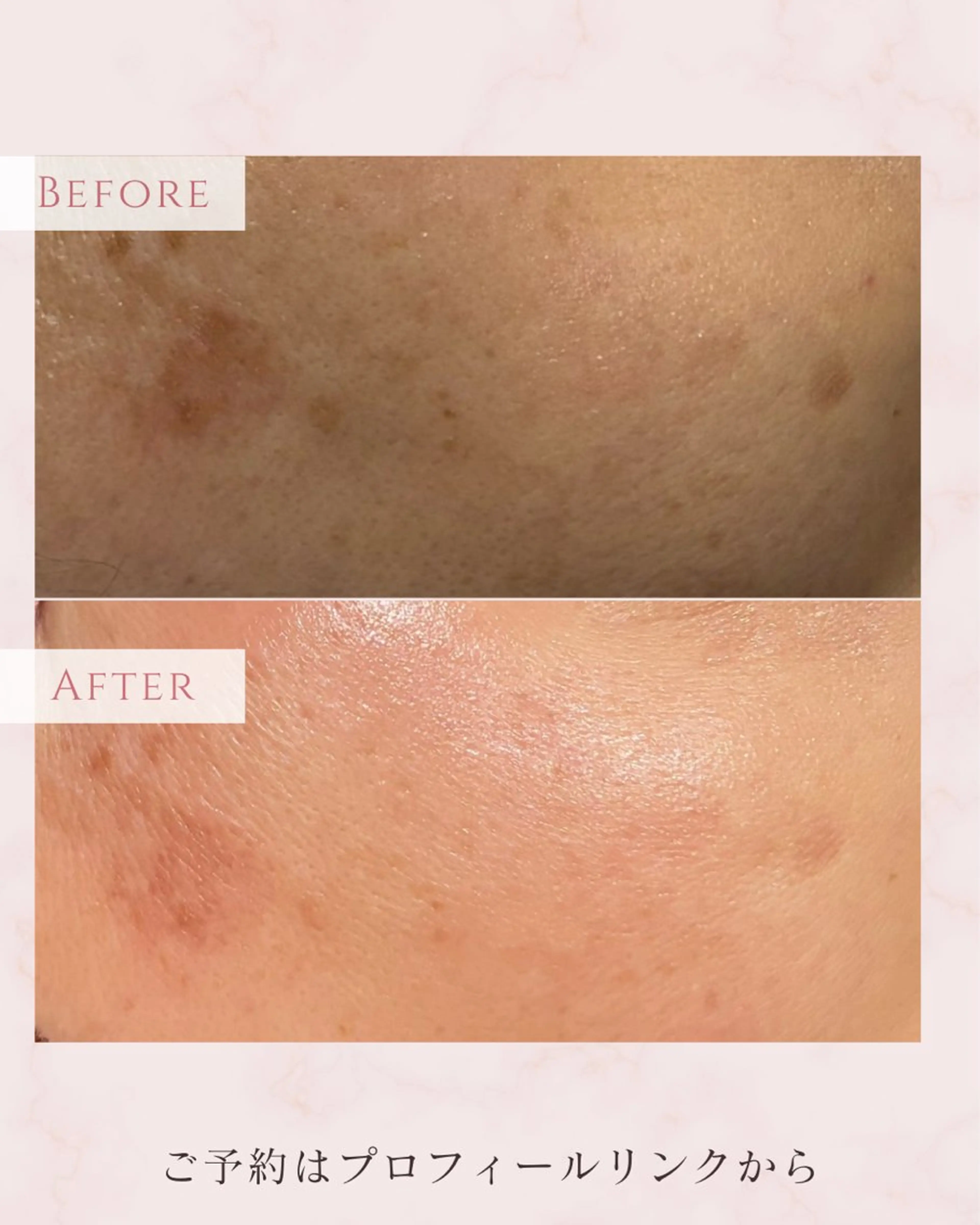 エステ 肌育フェイシャル🌿 noel🌿SAKIのエステ・リラクイメージ