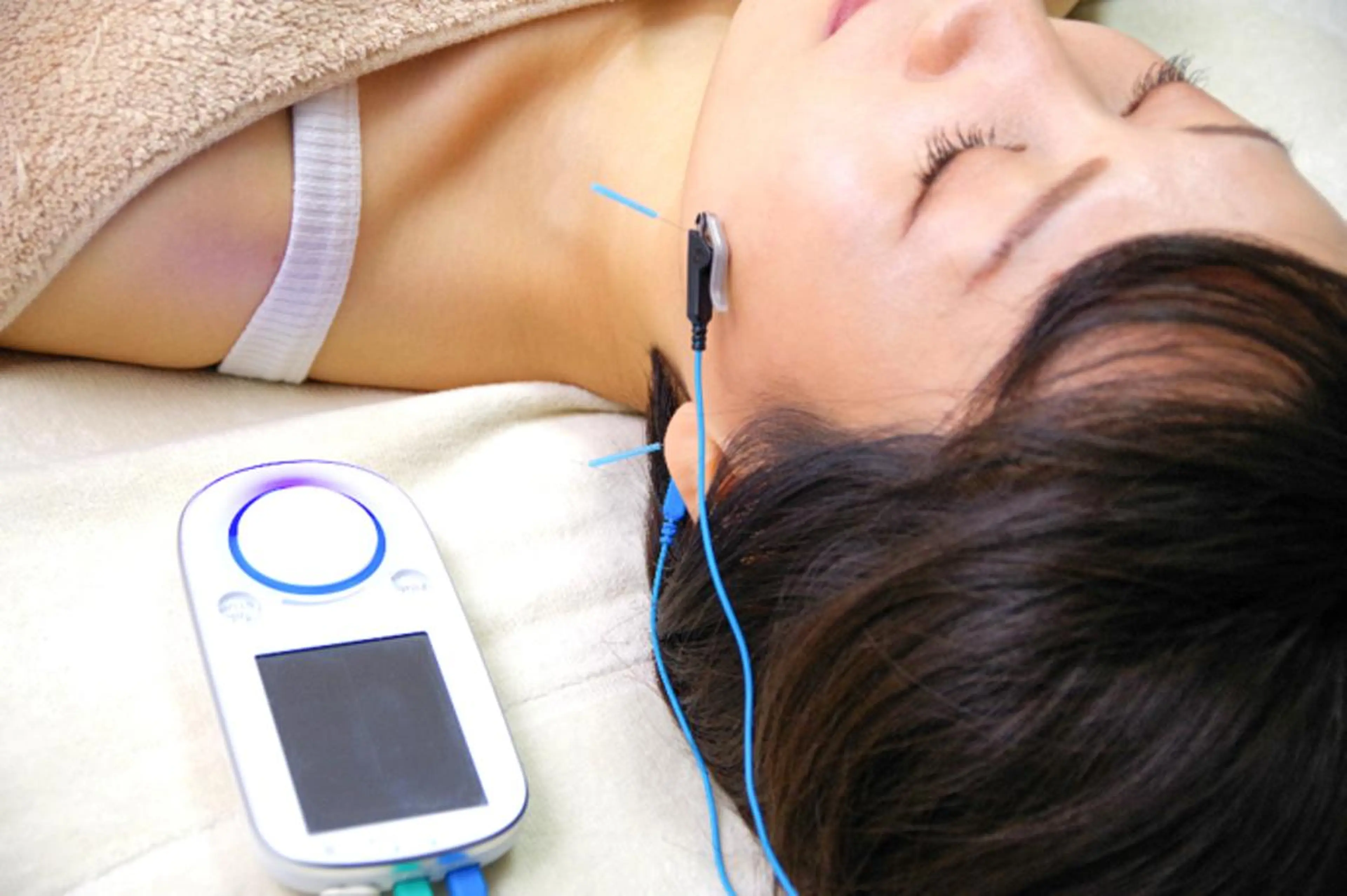 FN美容鍼☆医学博士監修の美容鍼（２回目のみ限定割引）の写真