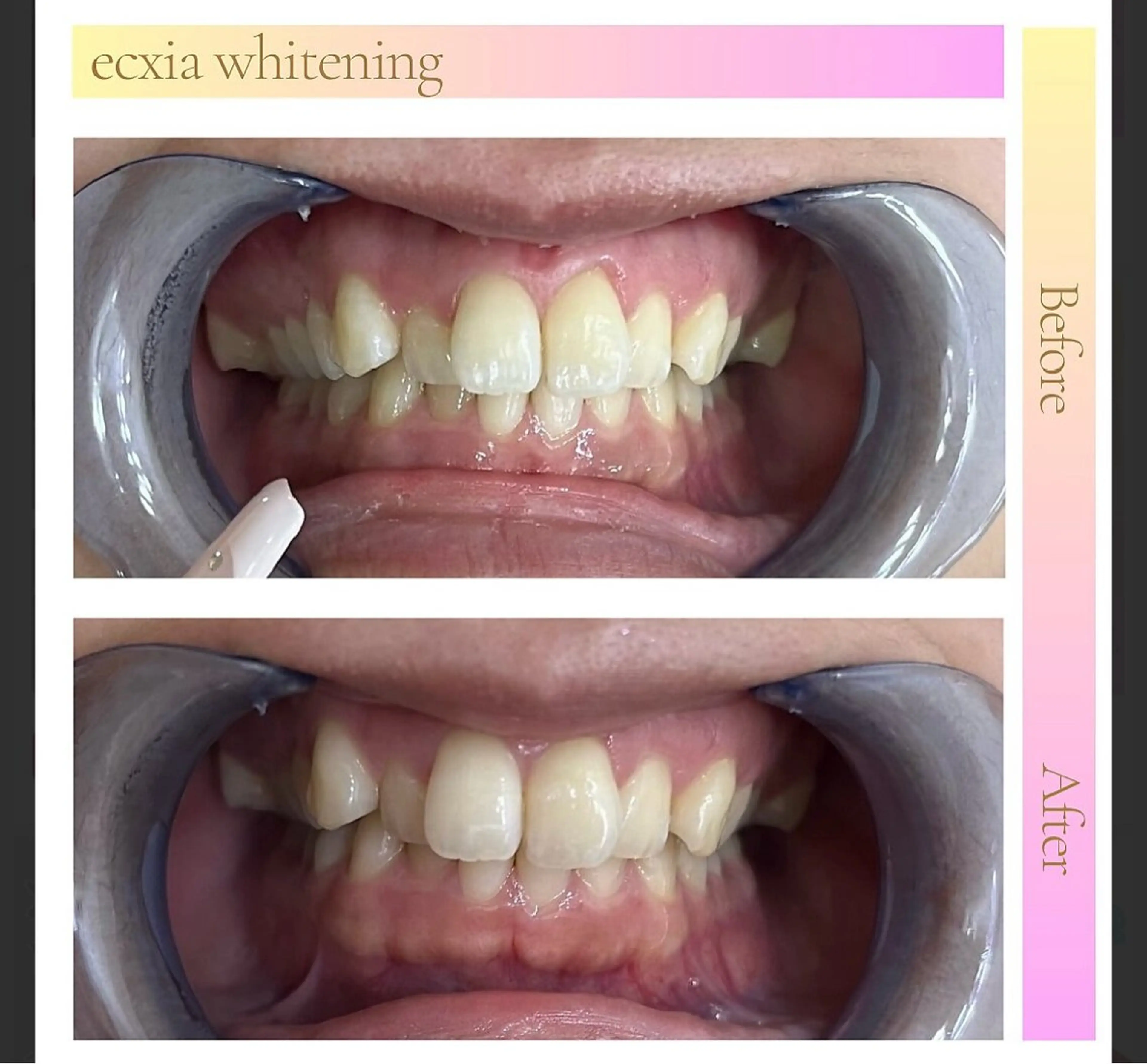 エクシアホワイト長野店所属・セルフホワイトニング エクシア長野店のその他イメージ