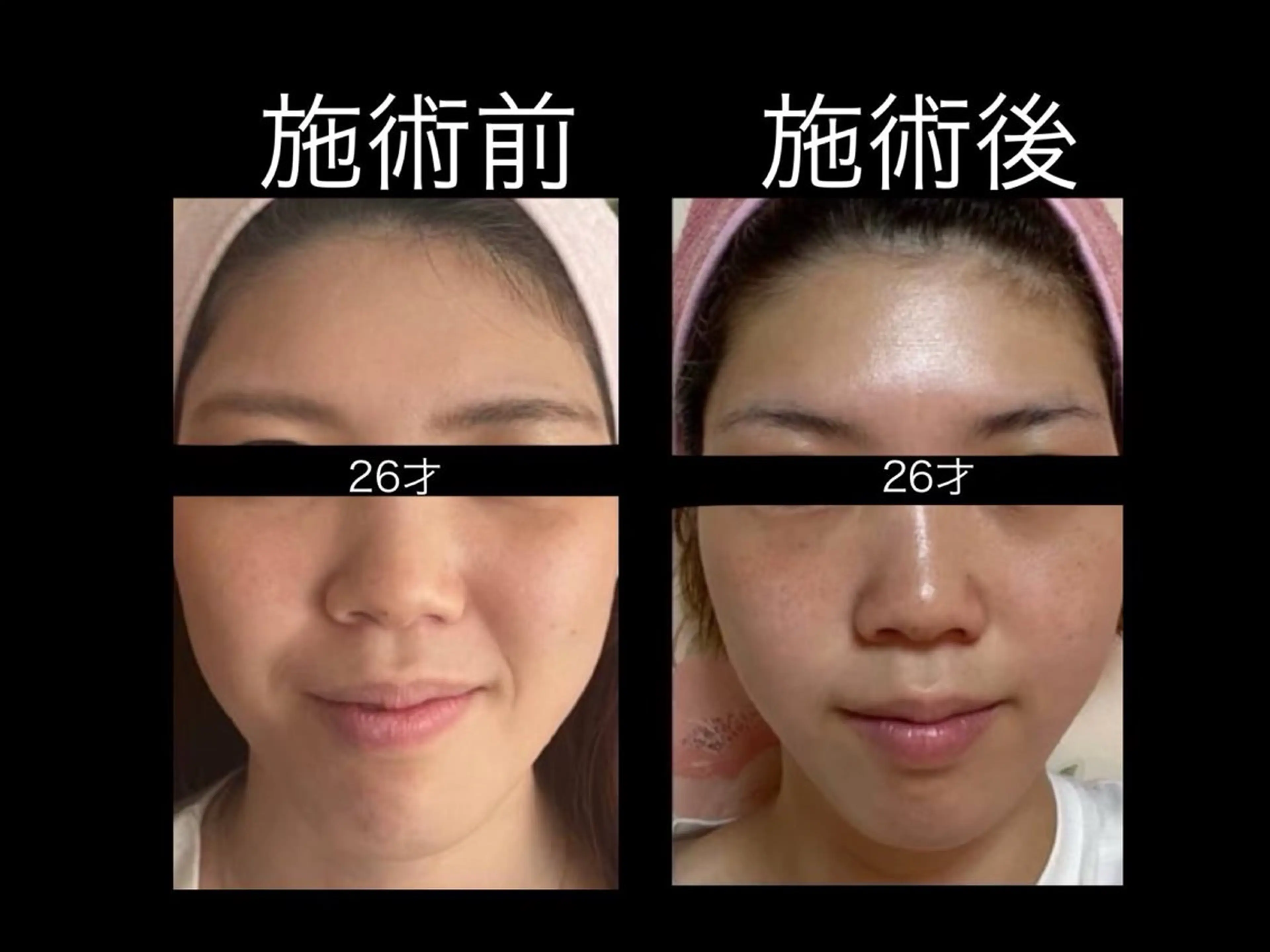 🌷エステ➕極上の美容液付きの写真