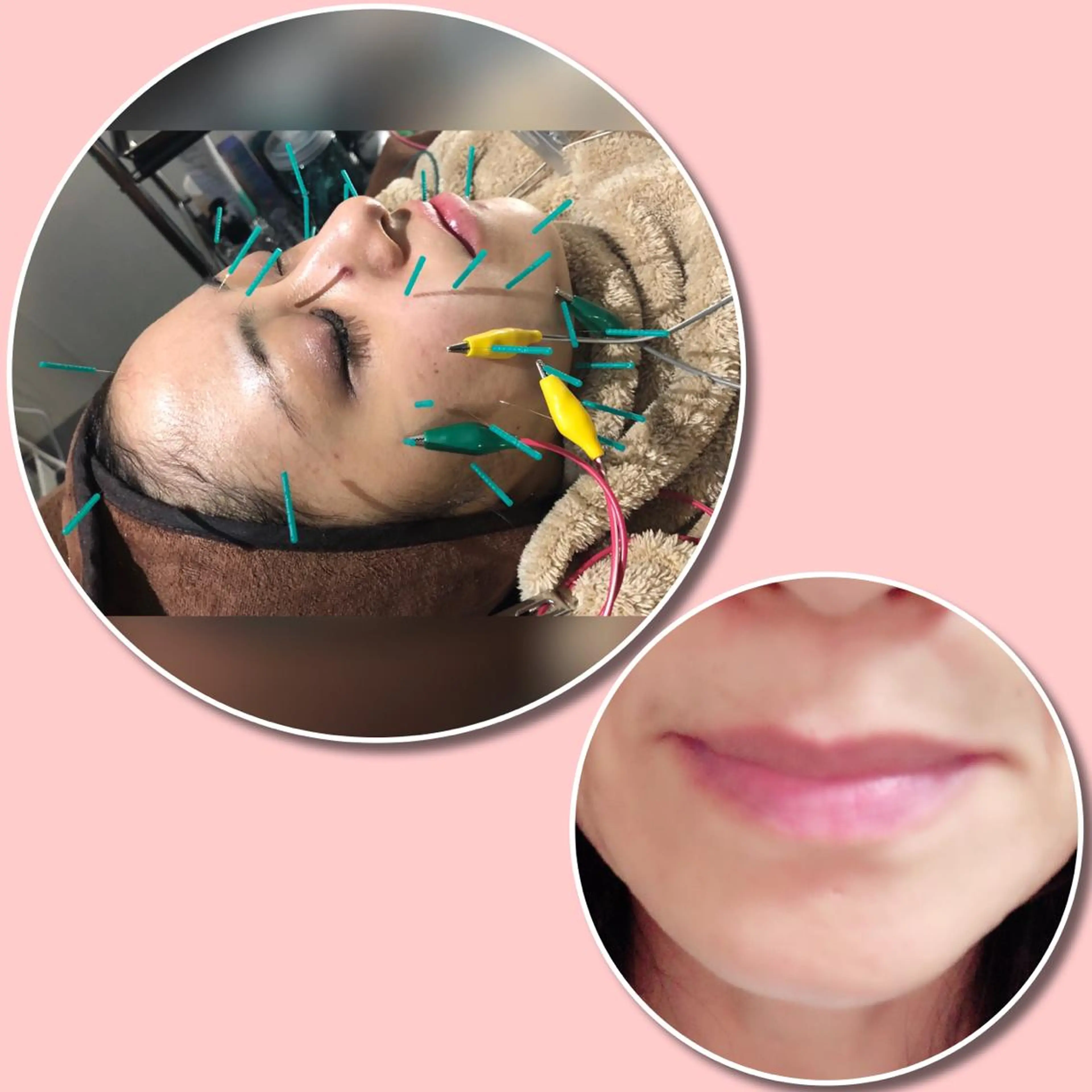 人気の💋🌟^_^🌟パルス美容鍼90分＋プルプルリップエステ💋の写真