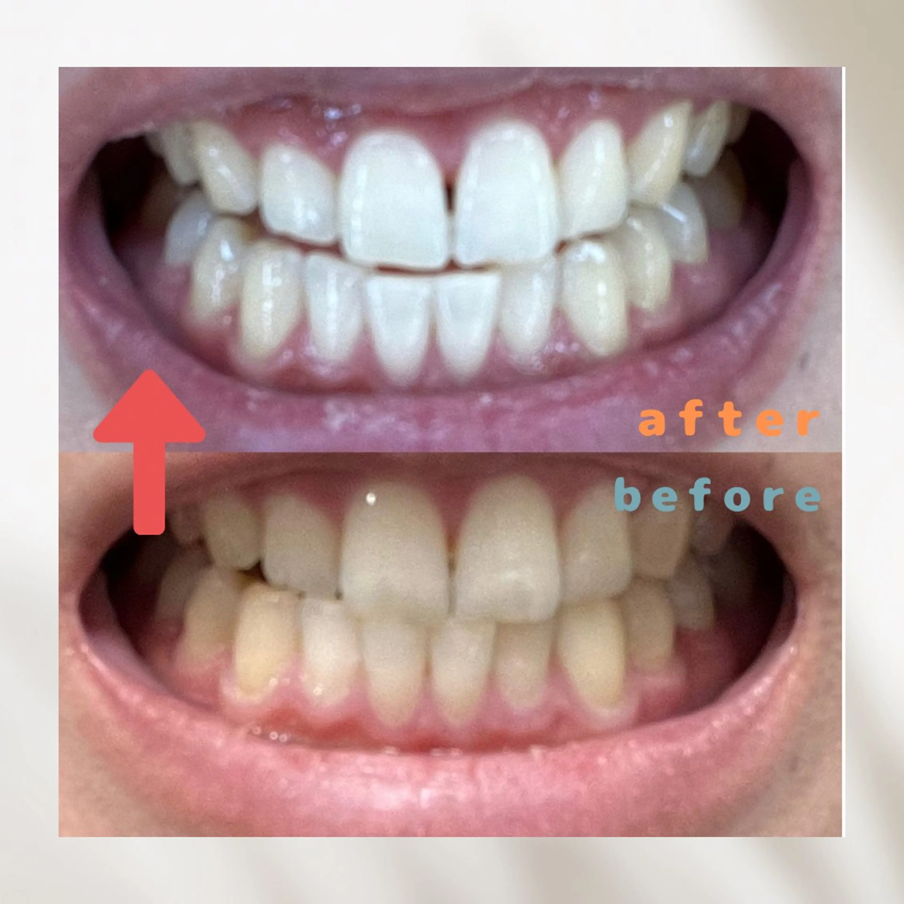 その他 エクシアホワイトニング草津店所属・nanami -ホワイトニングのその他イメージ