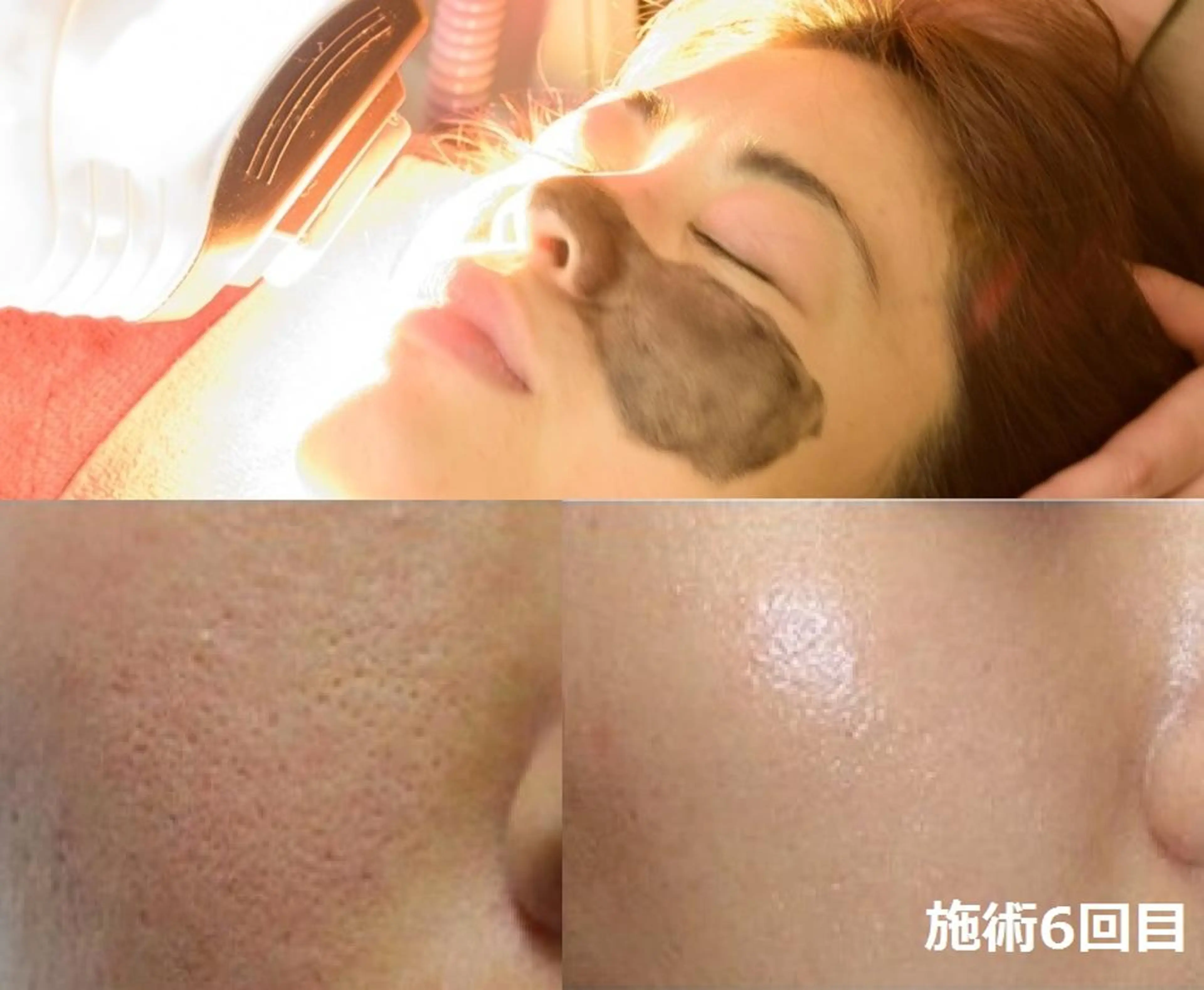 エステ 顔脱毛＆毛穴＆ニキビ 優良№1♪ヒロコ♪のエステ・リラクイメージ