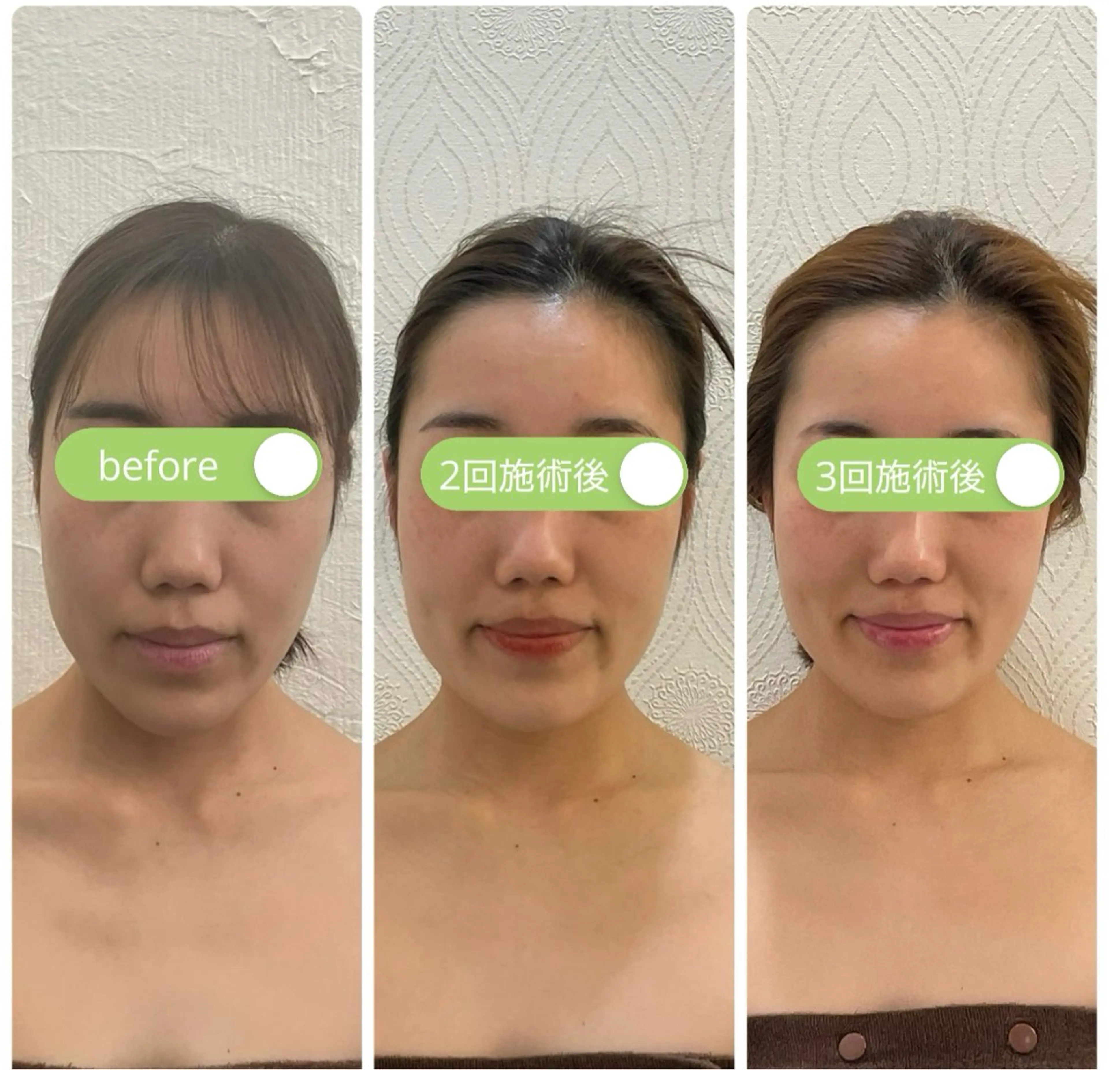 【新規】【平日限定】整形をお考えの前に!ダウンタイムのない整形級・頭蓋骨小顔矯正90分の写真