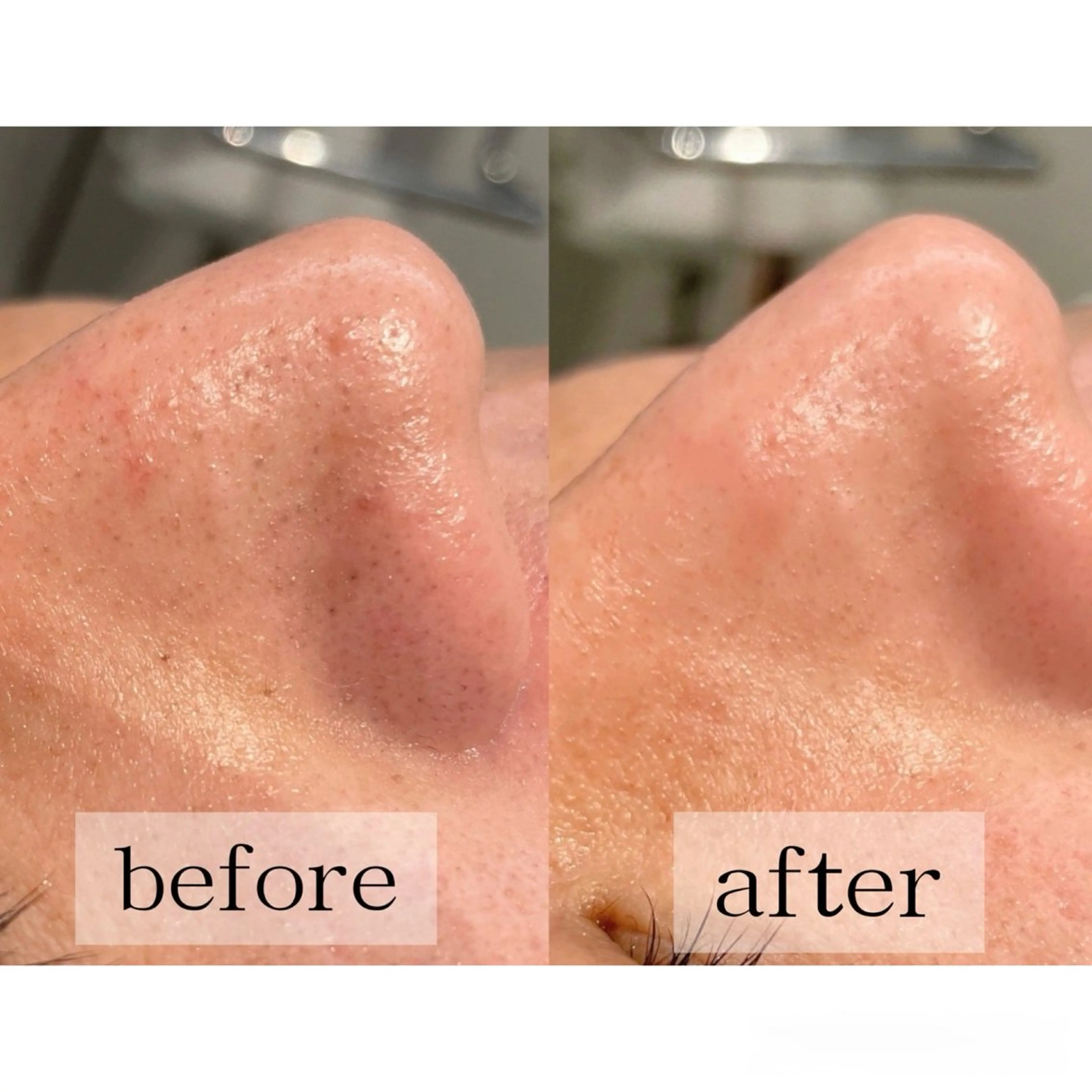 3月限定!!【毛穴/肌荒れ/乾燥ケア】最新水流🚿毛穴洗浄×イオン導入×プラズマシャワーの写真