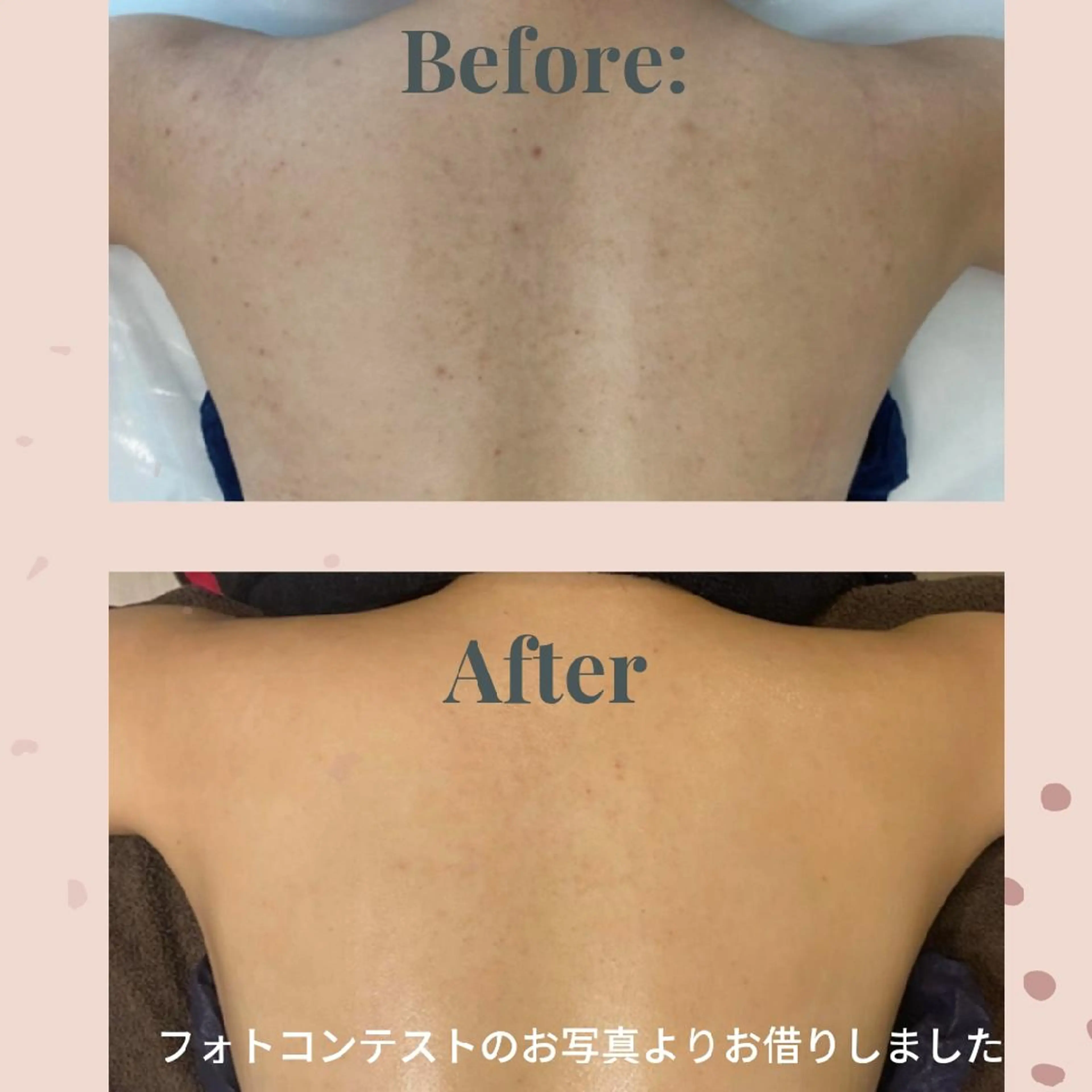 【背中ピーリング】ニキビ跡、ニキビ、シミなど✨自分ではケアしにくい背中のお悩みに集中ケア😉潤いながらつるるん肌に✨の写真