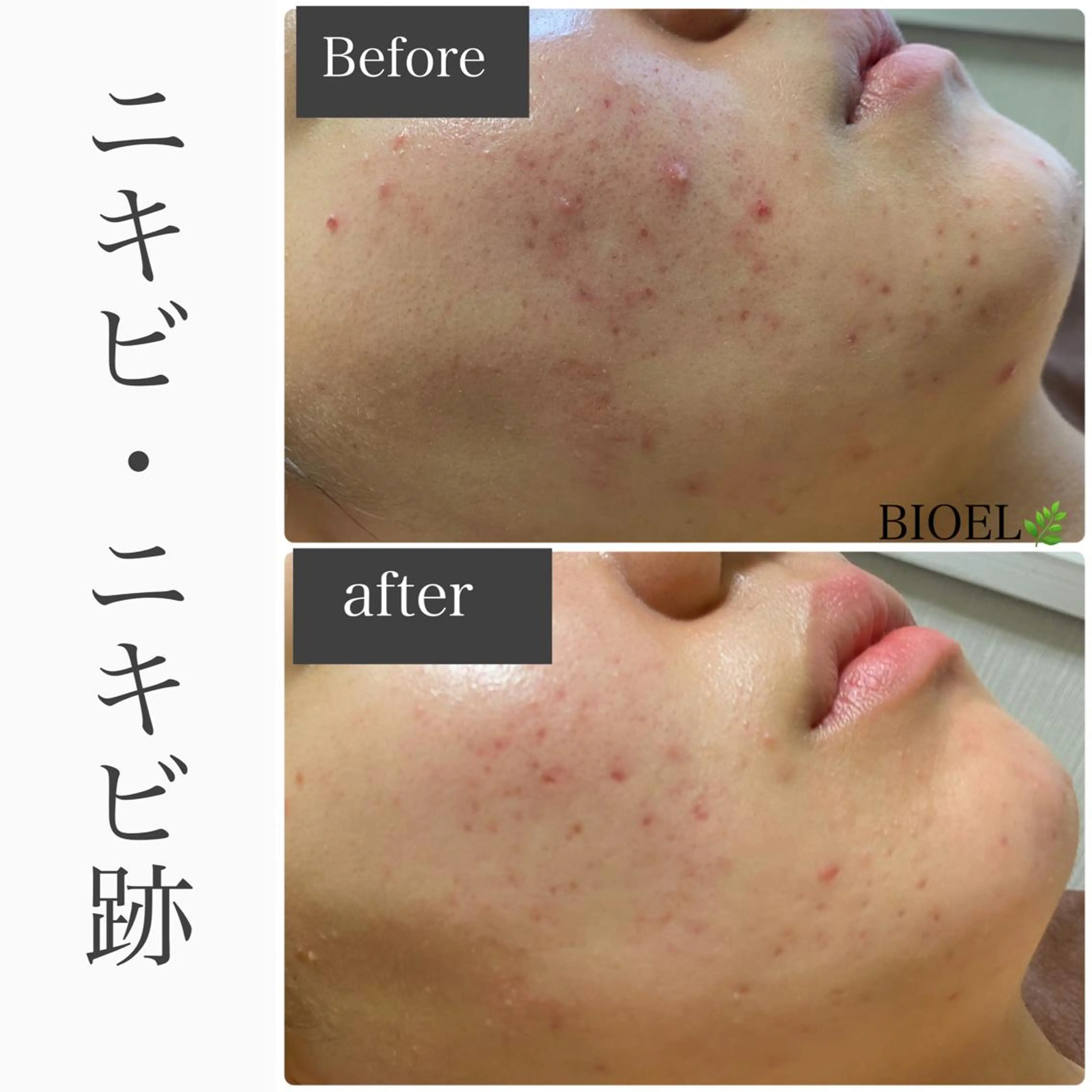 BeSkin藤沢店所属・ニキビ/肌質改善 BeSkin 藤沢店のエステ・リラクイメージ