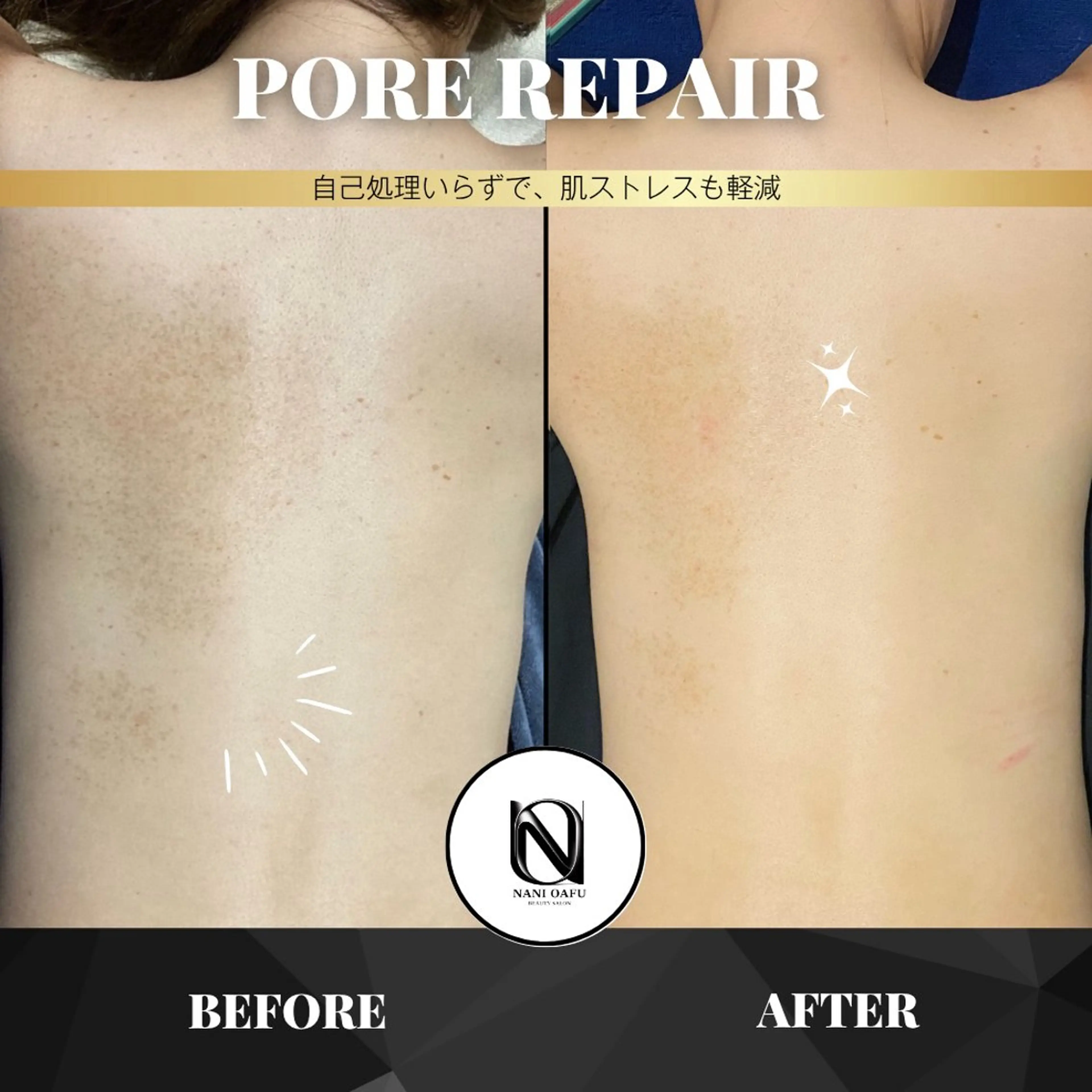【🫧背中ニキビ×毛穴詰まりケア】PORE REPAIR|自分では届かない背中に透明感を〈都度払いOK〉の写真