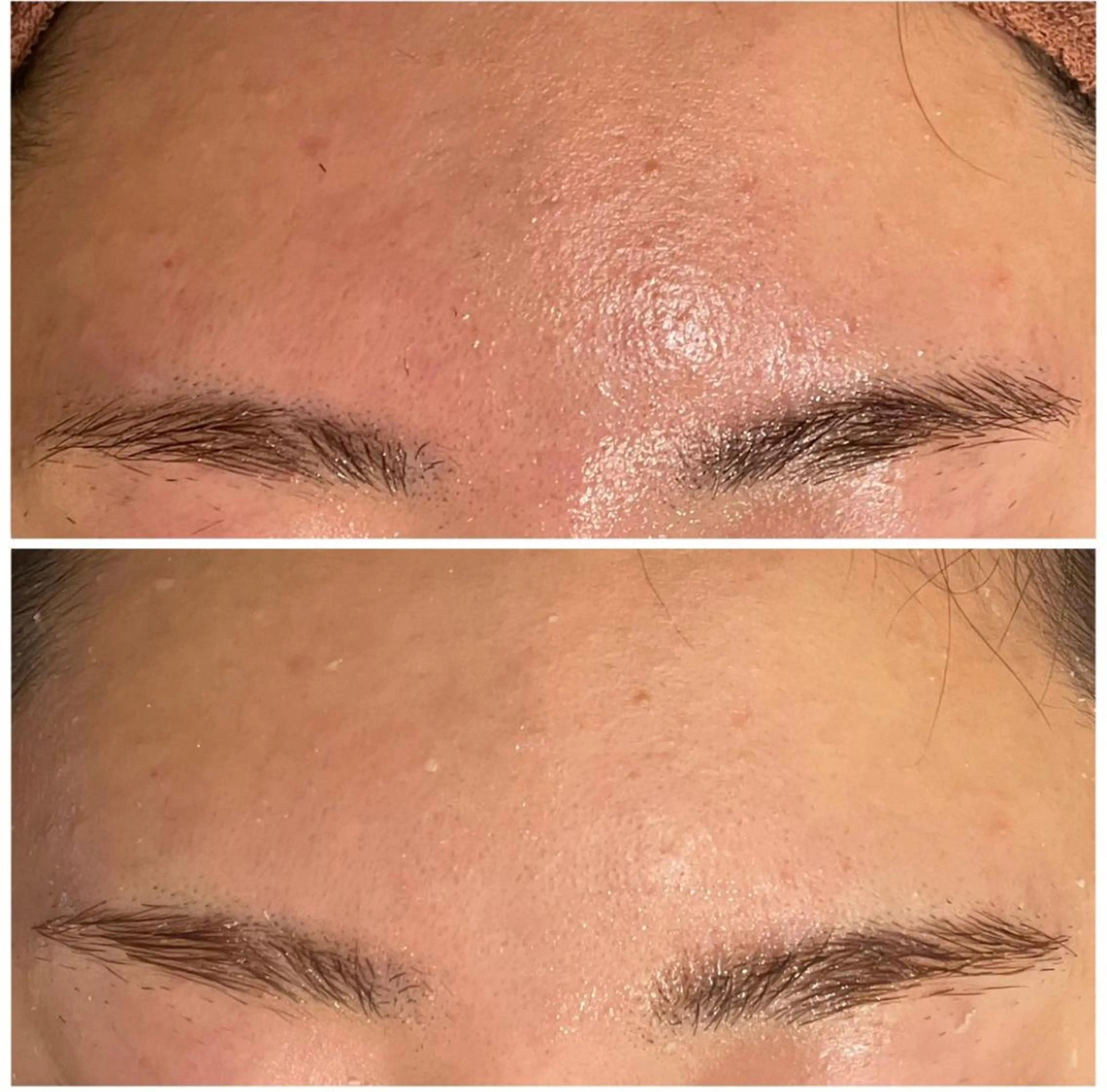 ニキビ特化型エステ 🍓最短で肌質改善のエステ・リラクイメージ