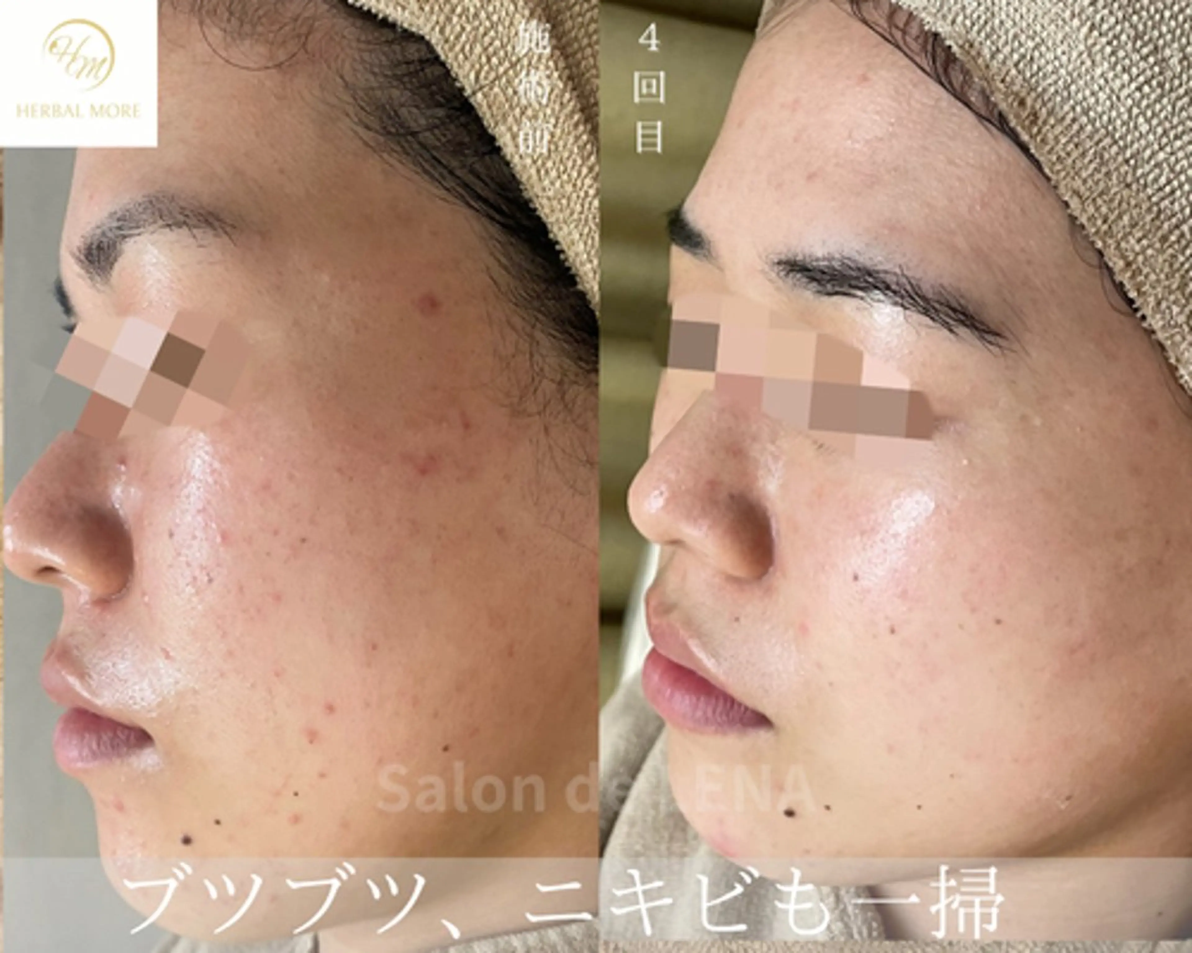 ハーブピーリング・毛穴ケア専門サロンSalon de LENA 栄店所属・ハーブピーリング専門 サロンドレナ　白藤のエステ・リラクイメージ