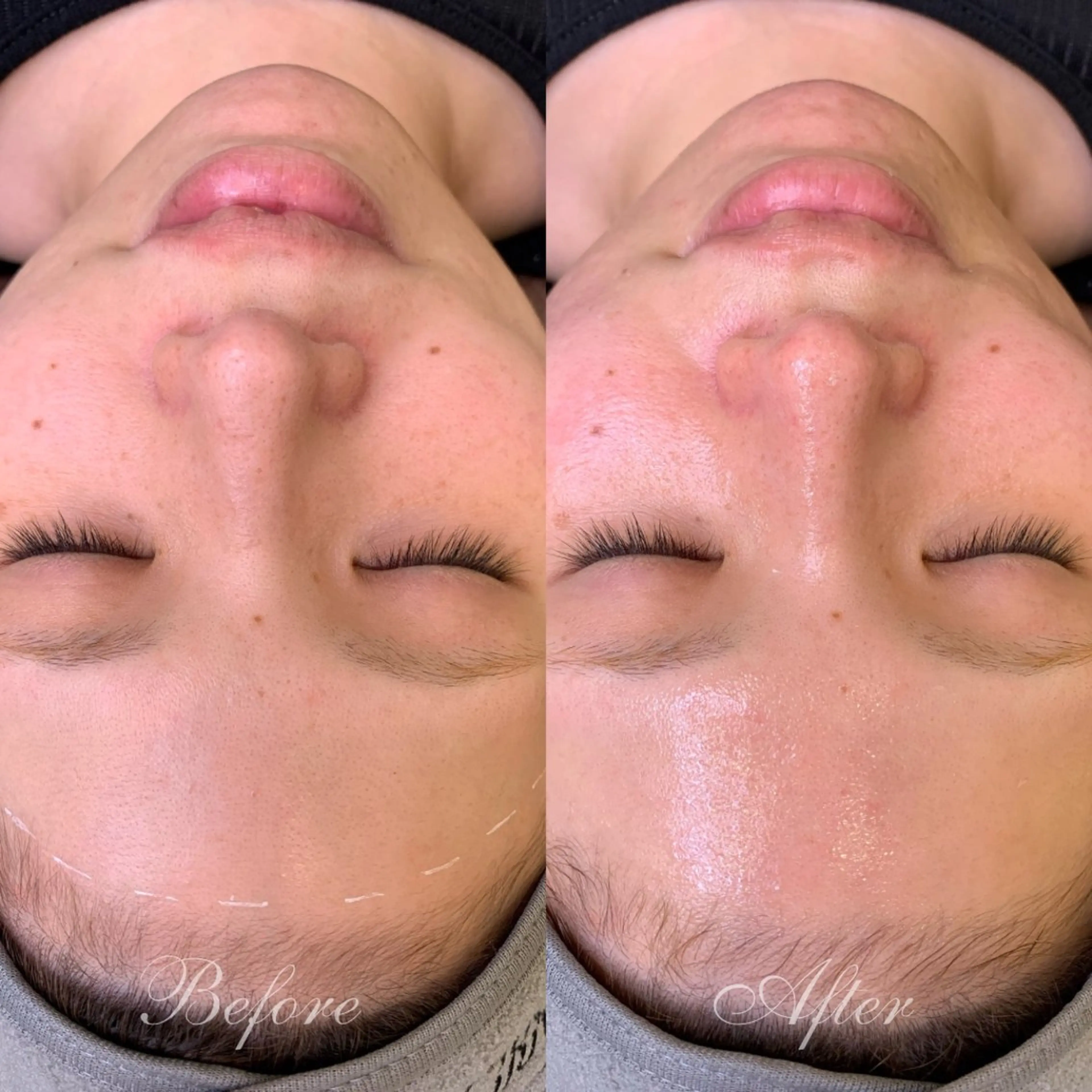 【フェイシャルワックス】最短3ヶ月で-5歳肌への写真