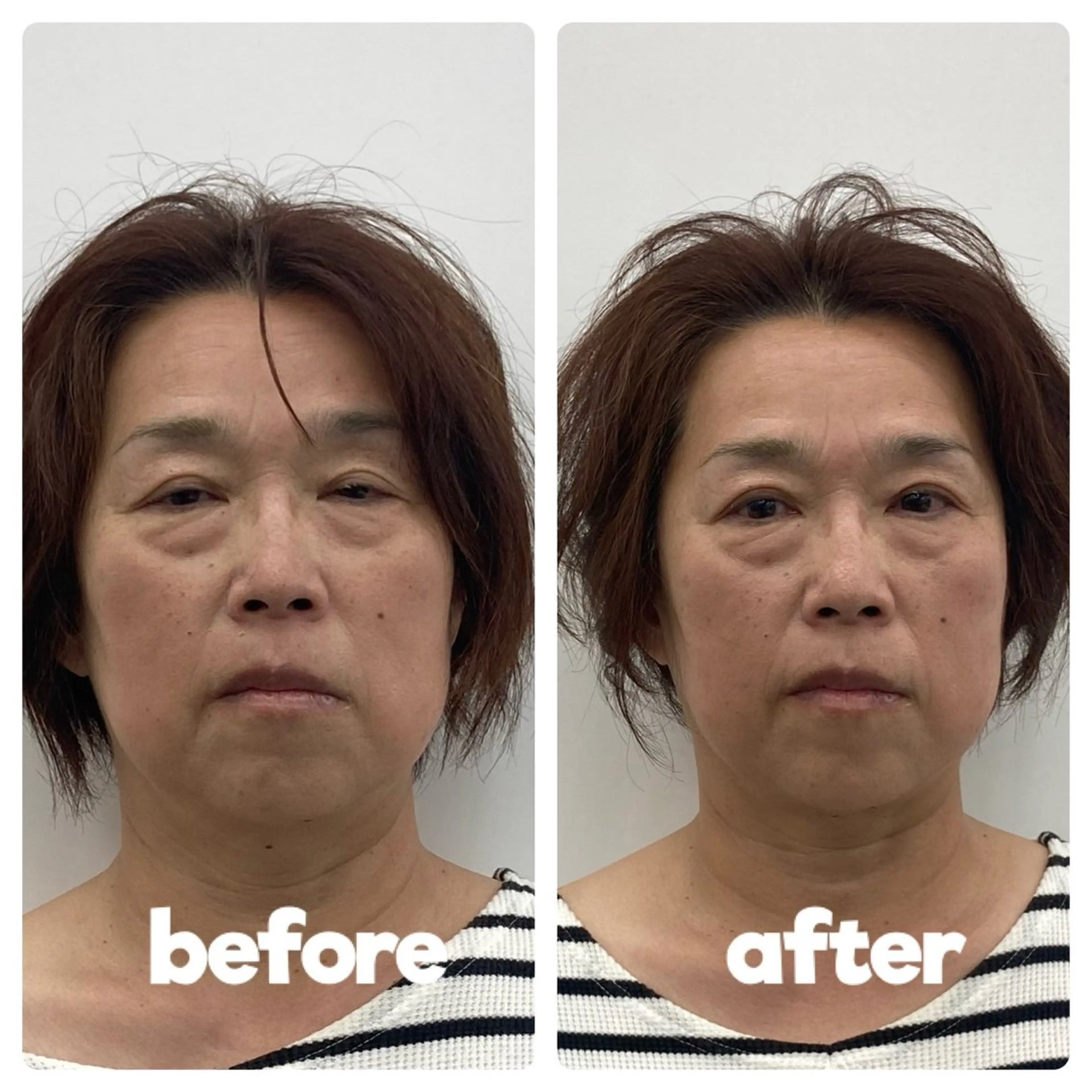 【エラ張り・頭痛】美容鍼×首肩こりマッサージ ¥10,000→¥4,980の写真