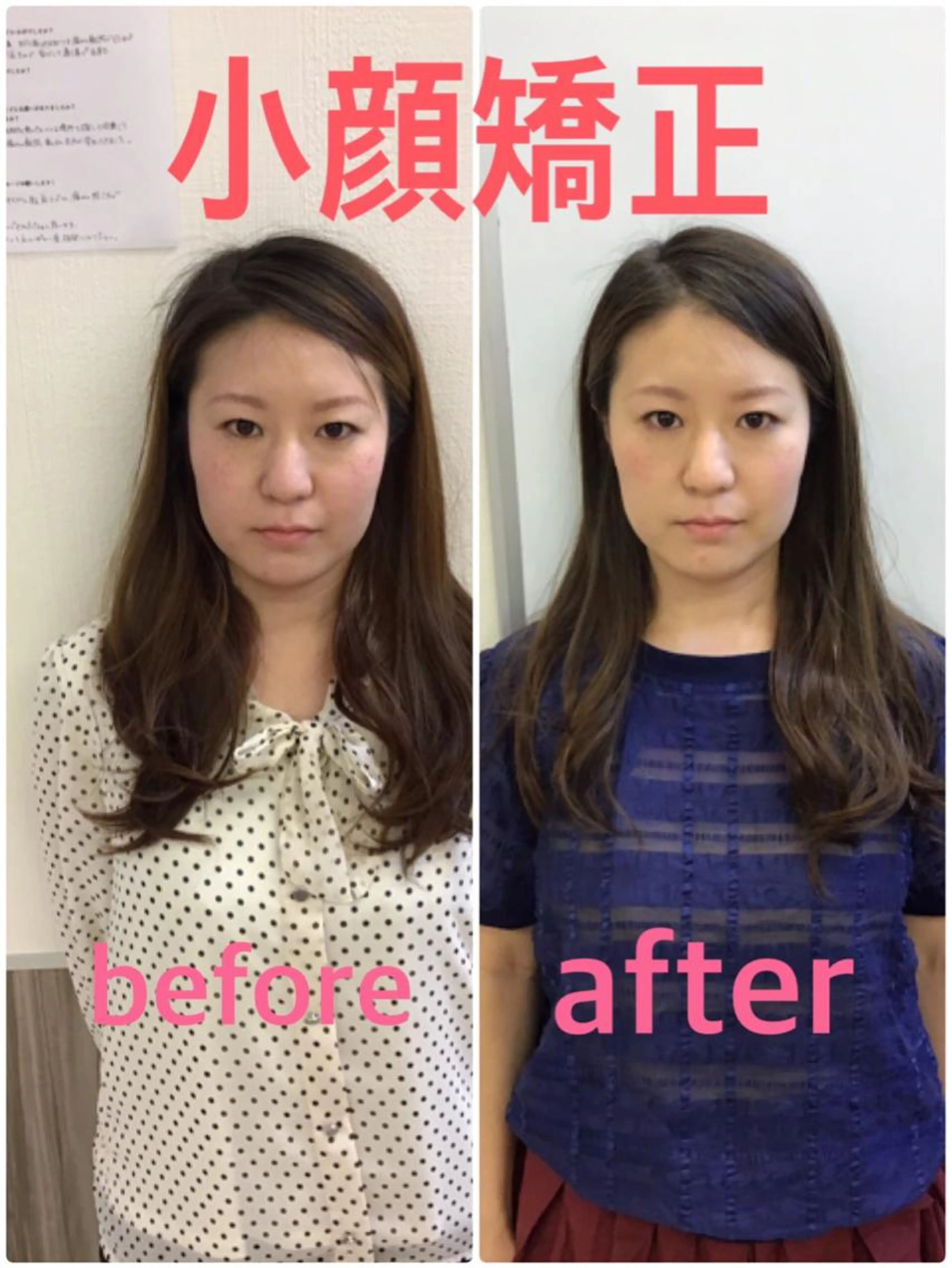 ク【ガチガチ肩こり／小顔】筋肉ふにゃふにゃ矯正✖️小顔矯正の写真