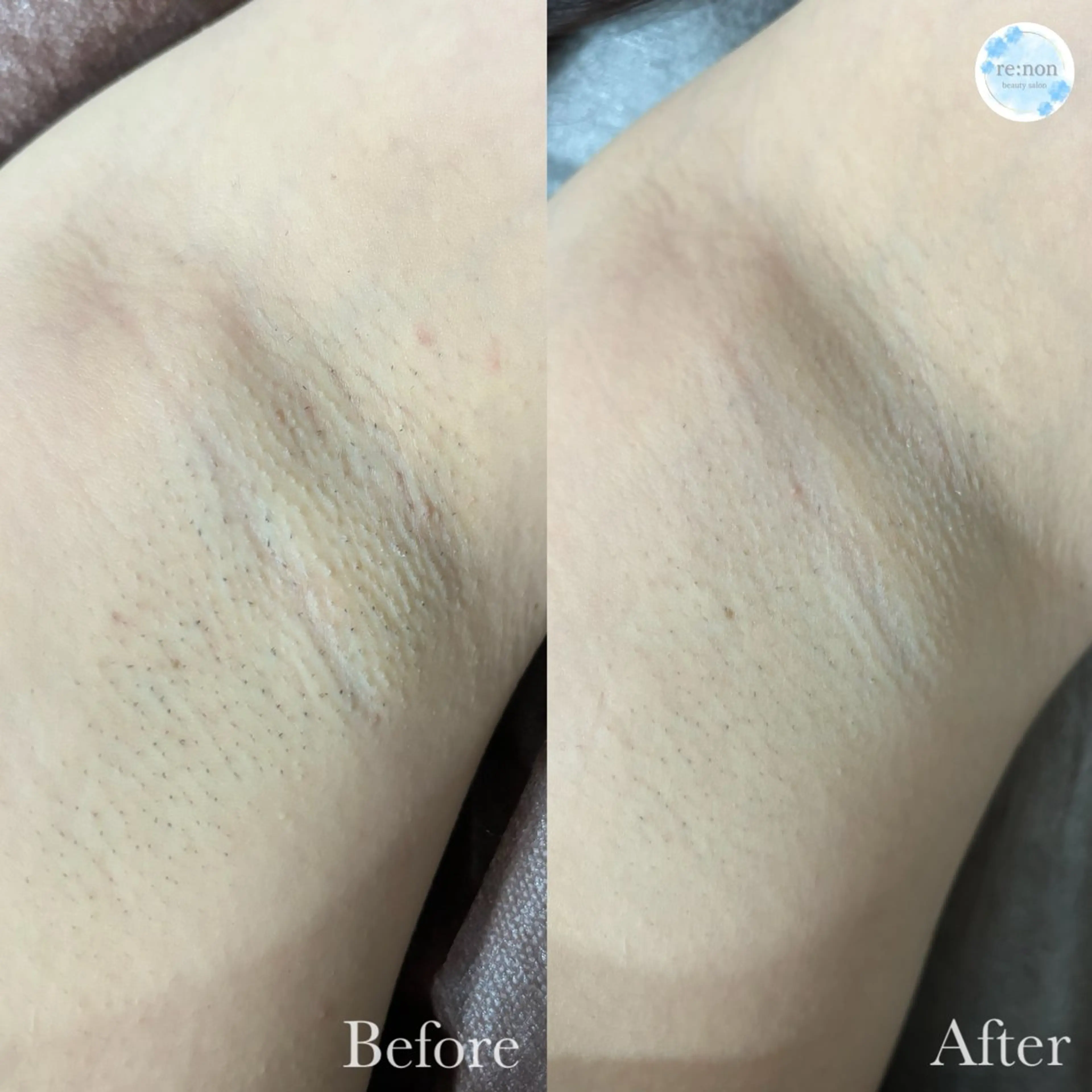 美容鍼脱毛salon リノン吹田駅前店のエステ・リラクイメージ