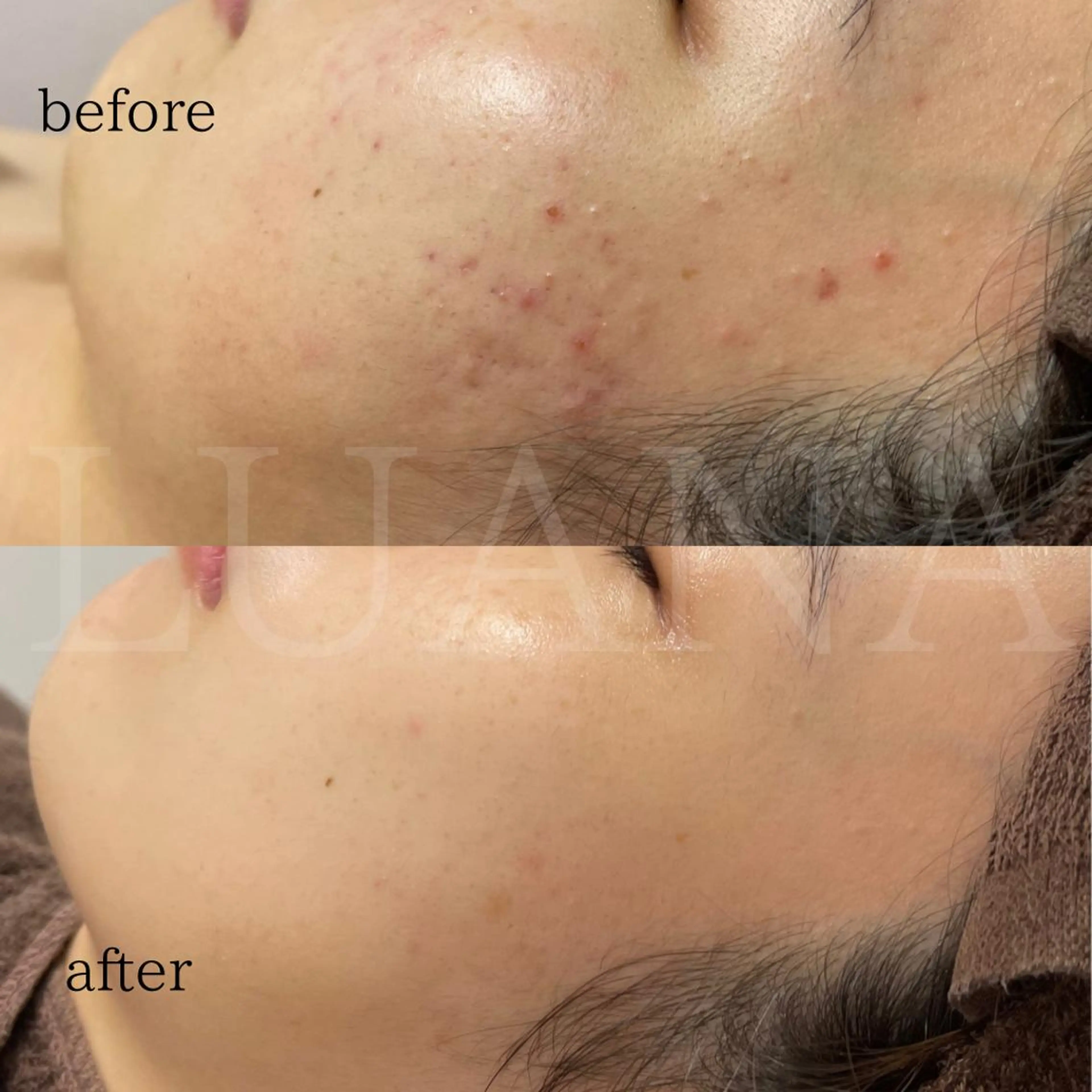 本気の肌質改善！もう肌で悩まない！今話題のVOSトリートメント(再来)の写真