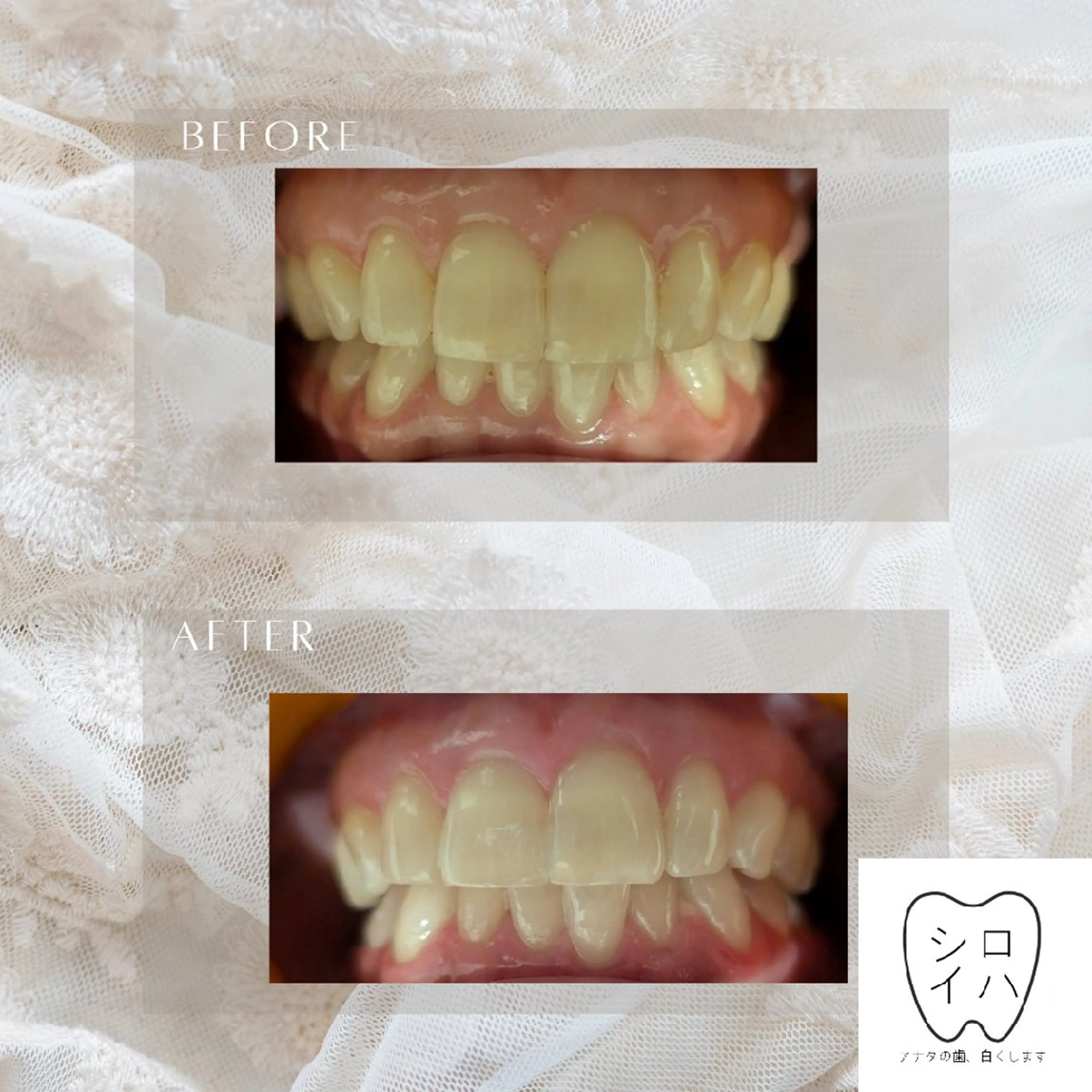 ホワイトニングサロン シロイハ所属・歯を白くしたい方🦷 シロイハのその他イメージ