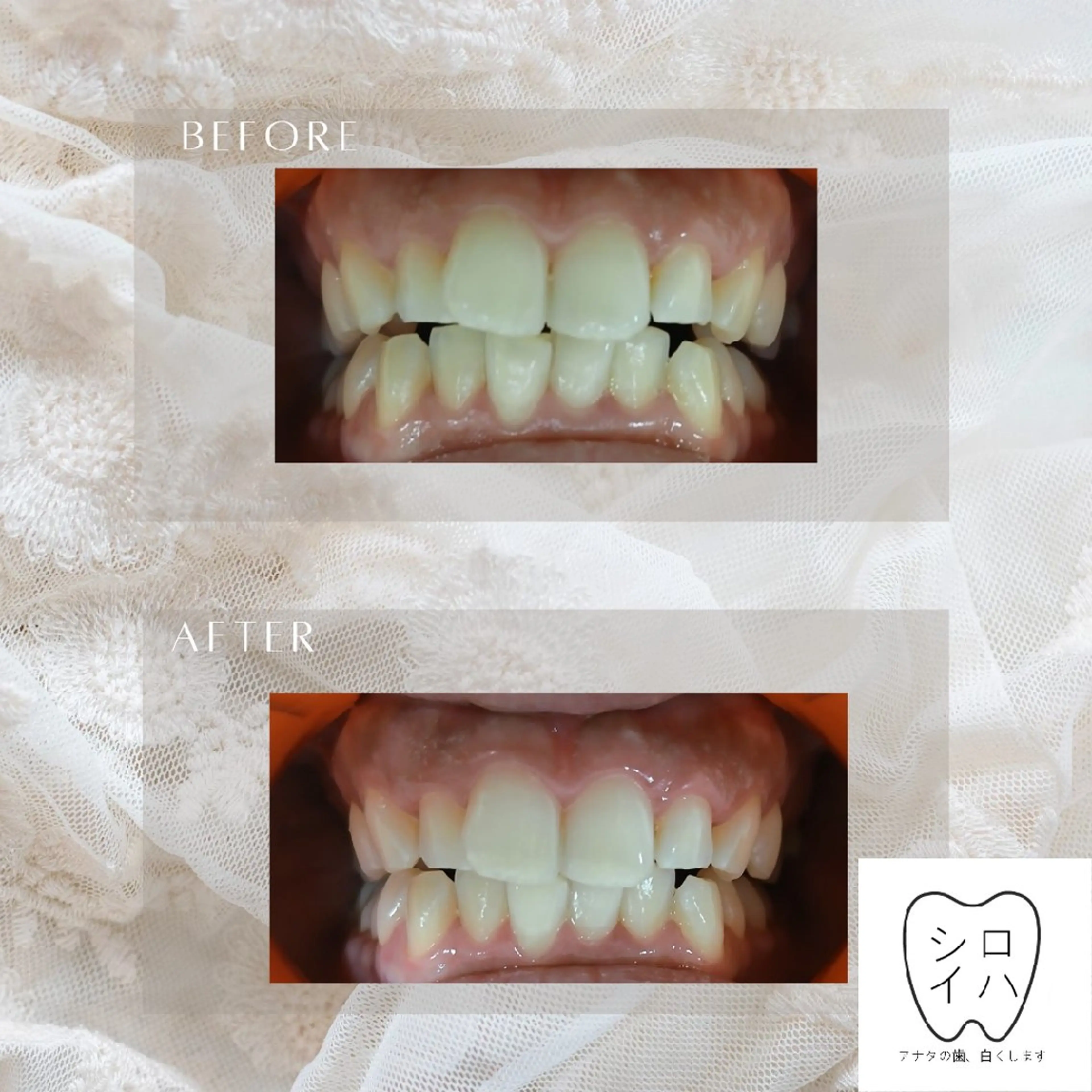 ホワイトニングサロン シロイハ所属・歯を白くしたい方🦷 シロイハのその他イメージ