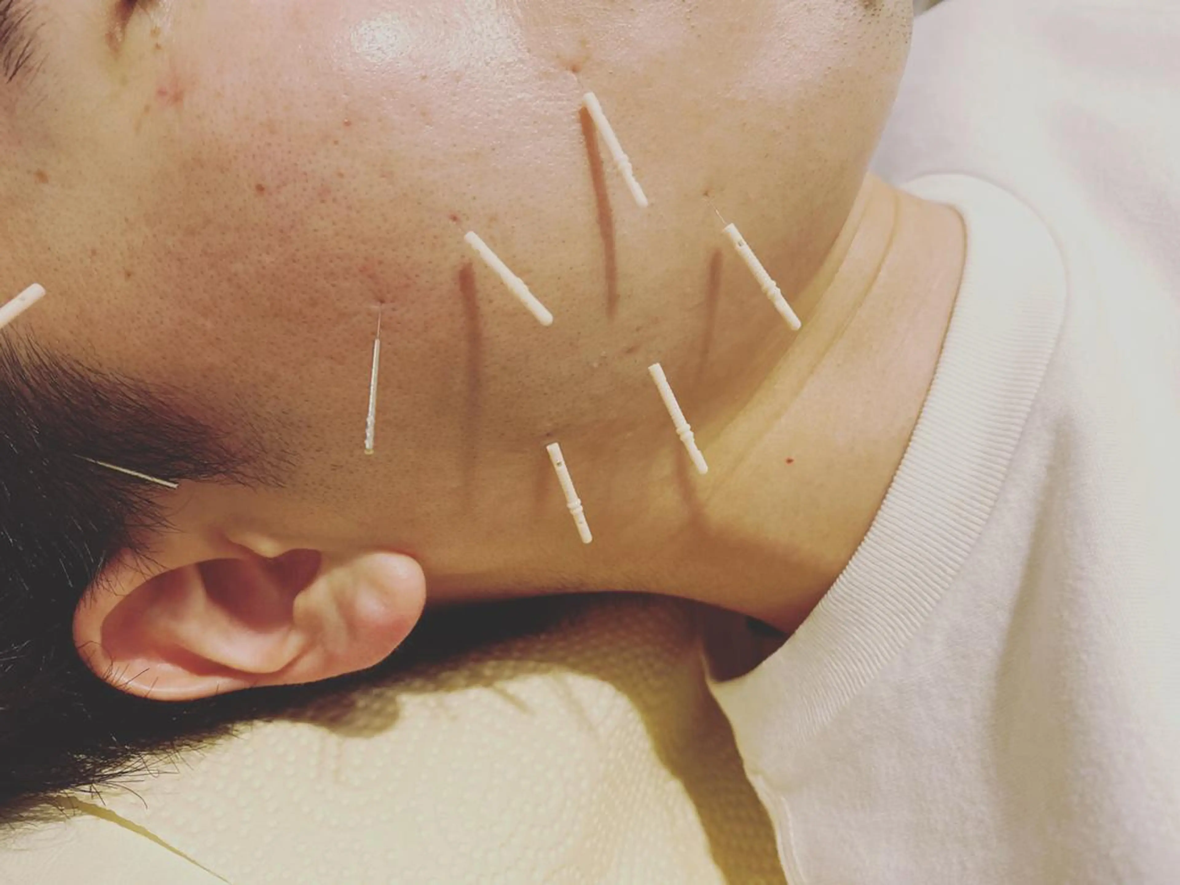 むくみたるみ専門☆ 美容鍼・小顔矯正のエステ・リラクイメージ