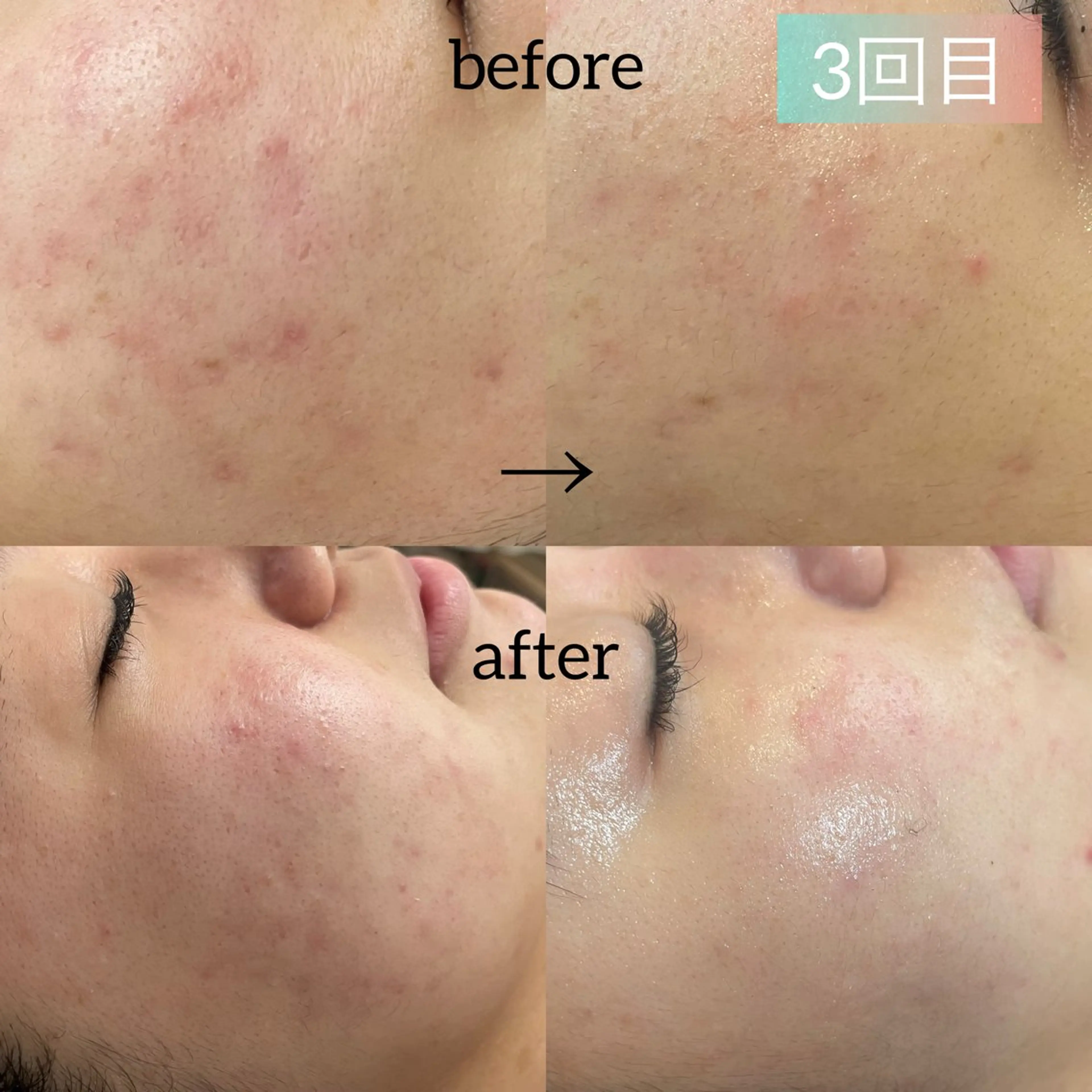 剥離なしハーブピーリング 3回施術後で随分赤みが減って、トーン