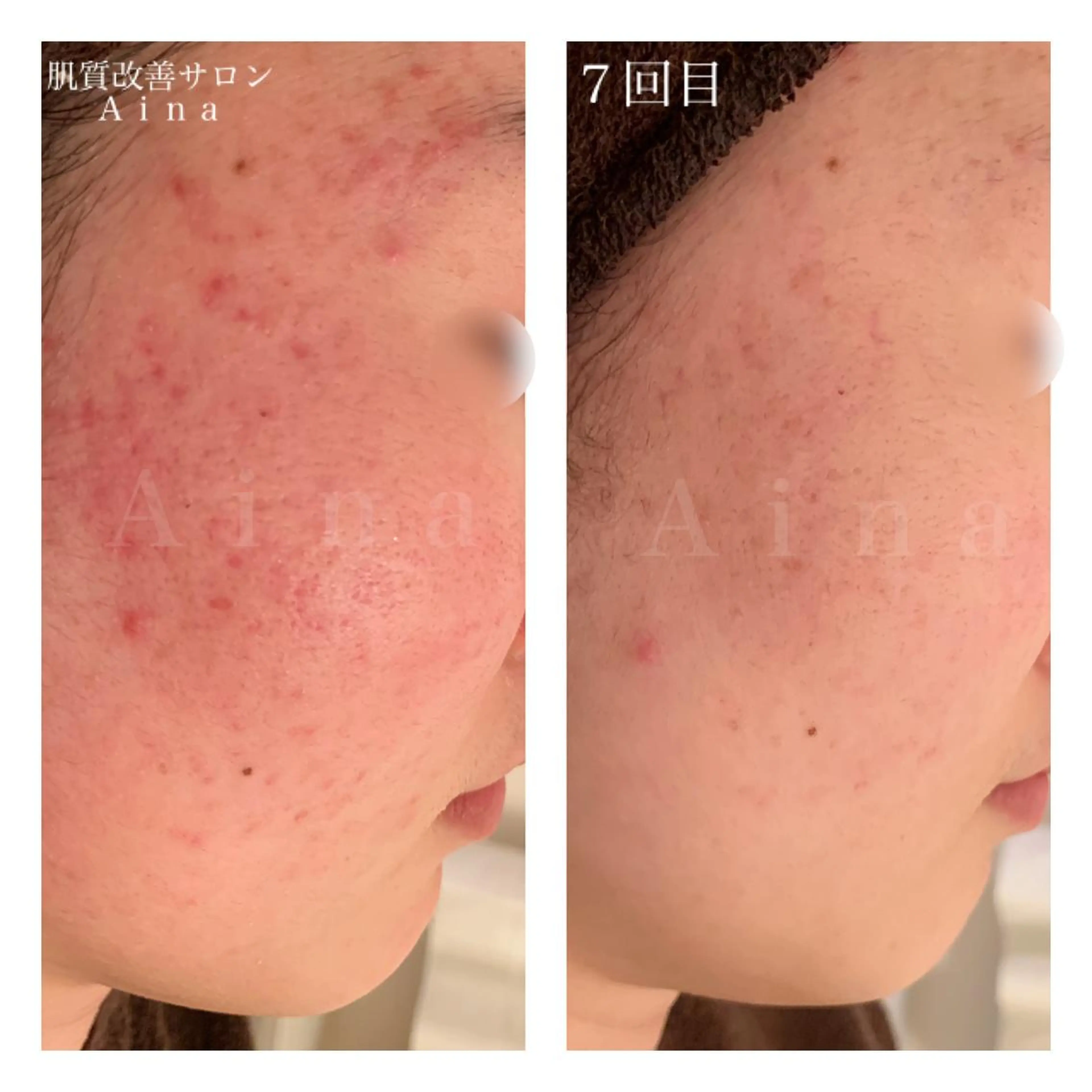 セミロング カラー パーマ ヘアアレンジ メンズ キッズ ネイル マツエク・マツパ ニキビ跡専門サロン Ａｉｎａのエステ・リラクイメージ