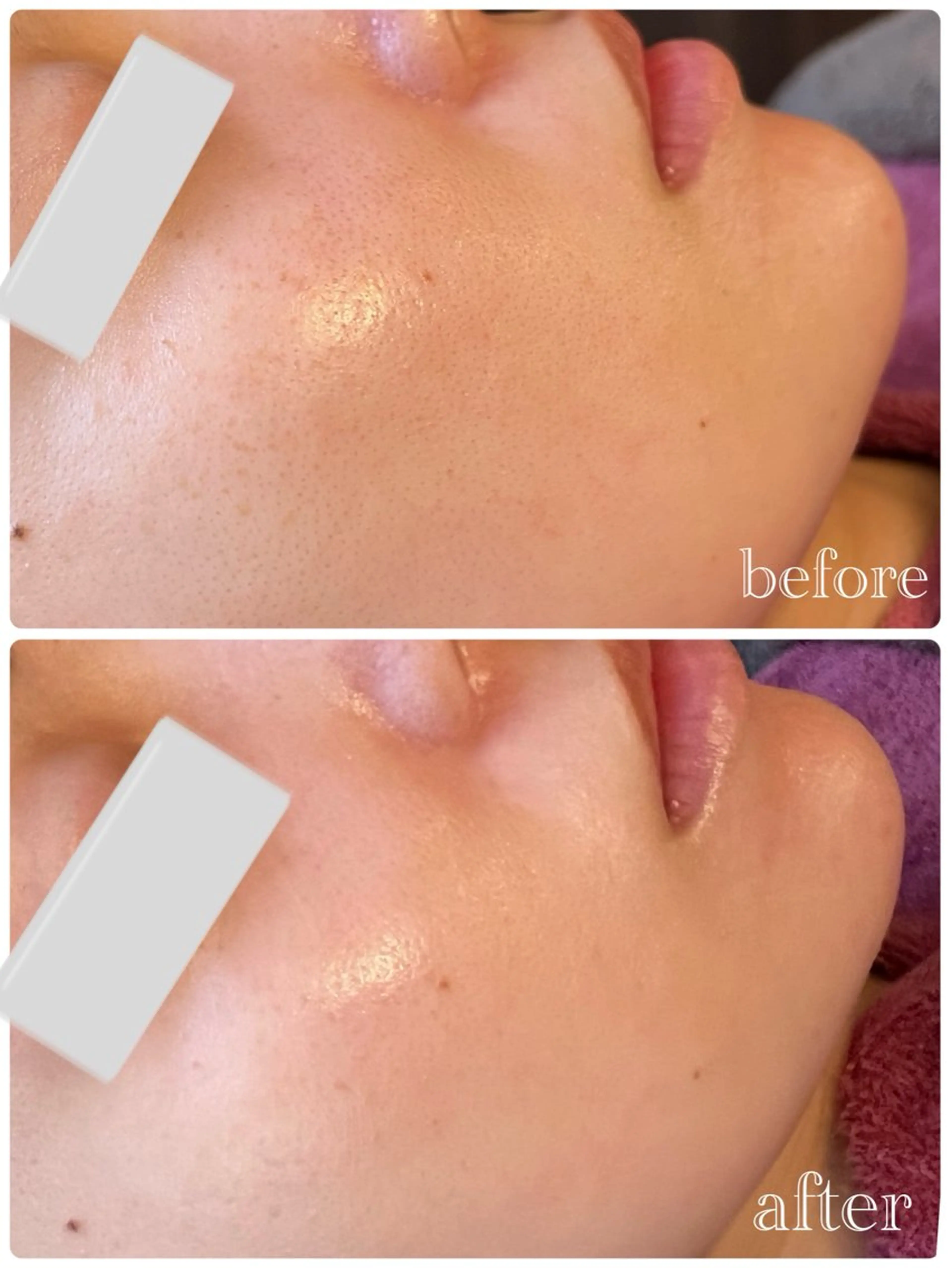 【ミニモSALE💘】💎剥離なし！ニキビ・毛穴改善◎肌再生ハーブピーリング60分の写真