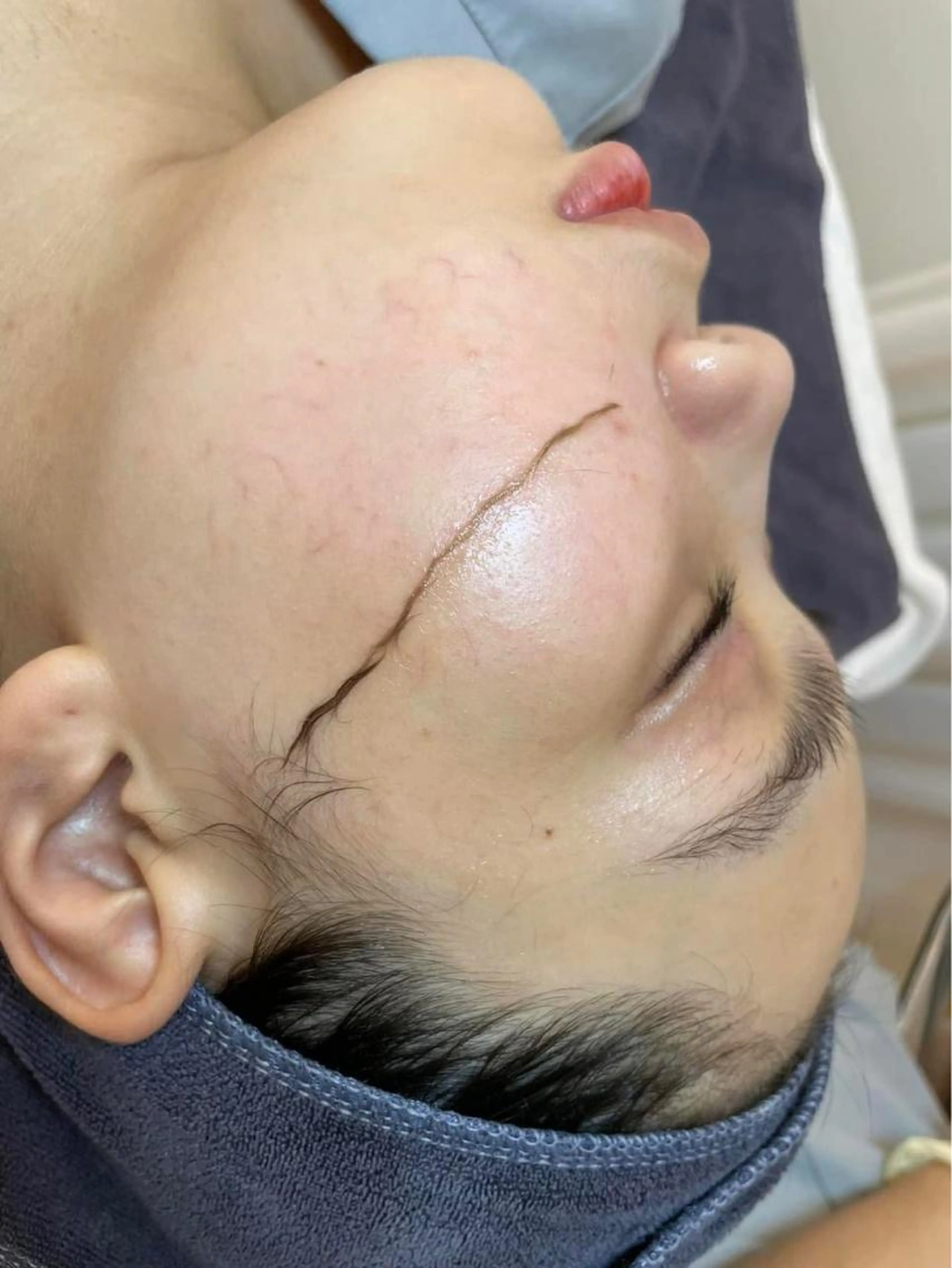 [超人気ダーマプレーニング]💖💖 すぐに効果的（お顔の毛と角質細胞を取り除き、完璧な肌を回復します) 75分の写真