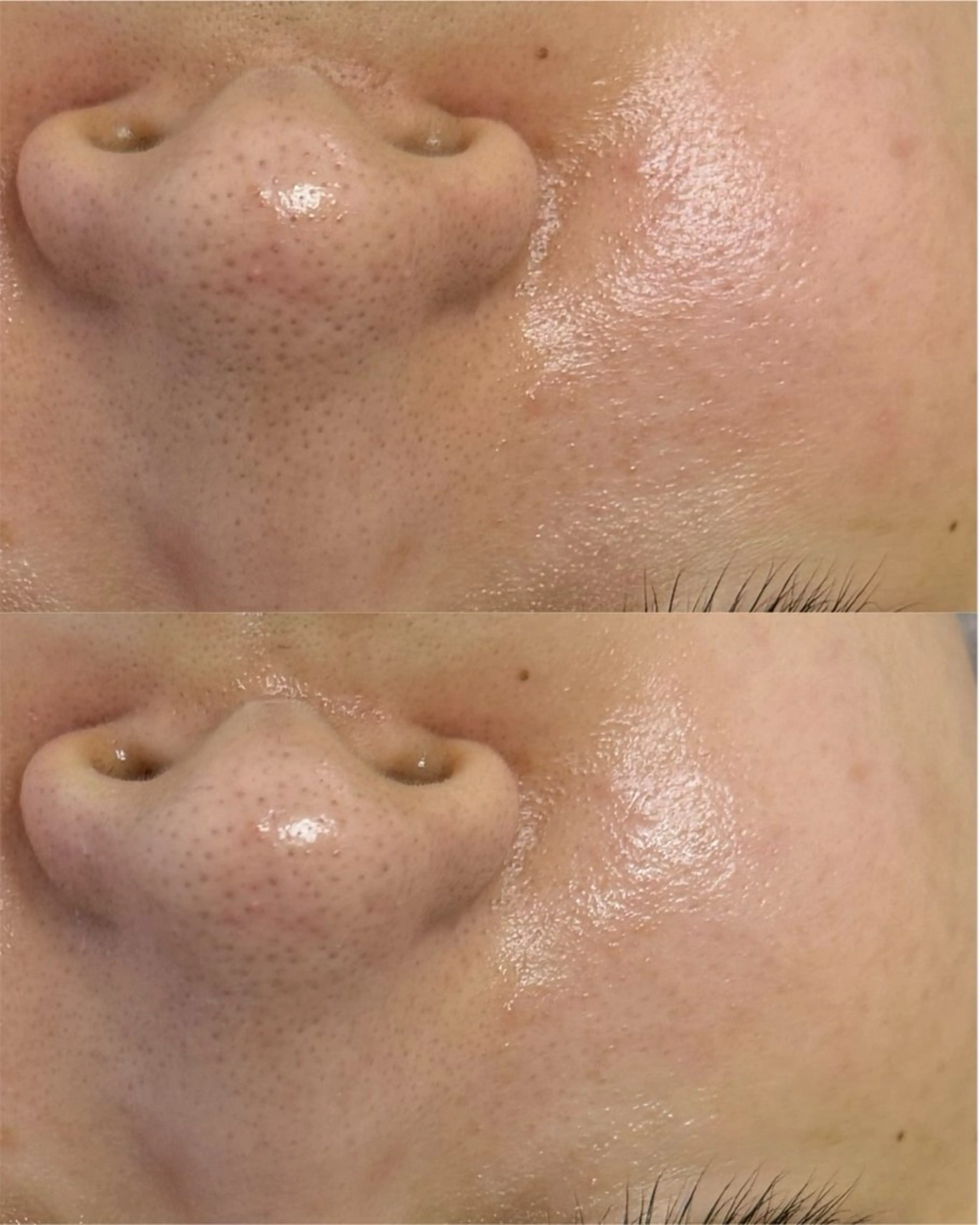 【毛穴集中ケア】毛穴引き締め高周波（選べる1パーツ）✨の写真