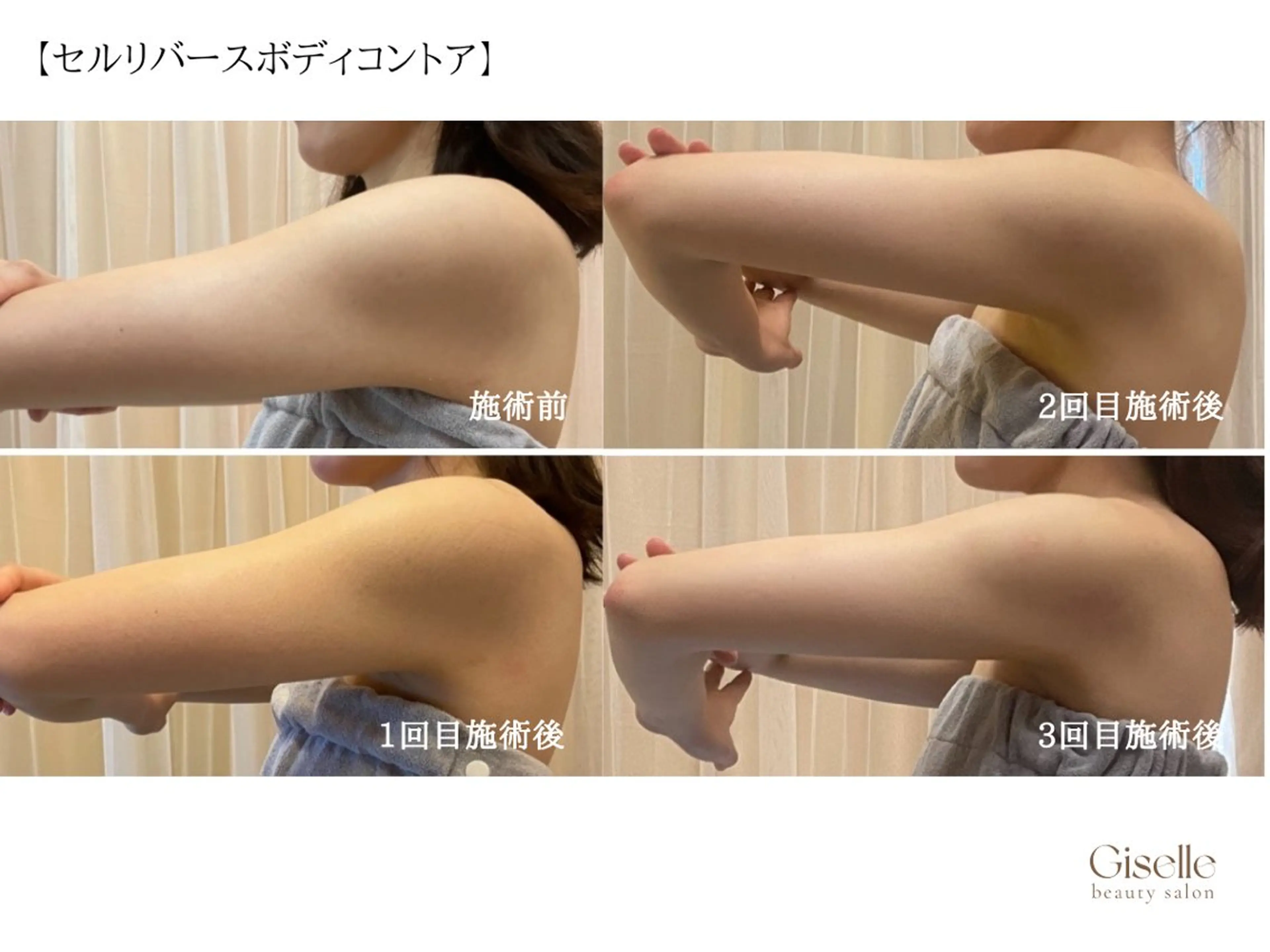 【セルリバースボディコントア】落ちにくい脂肪に◎の写真