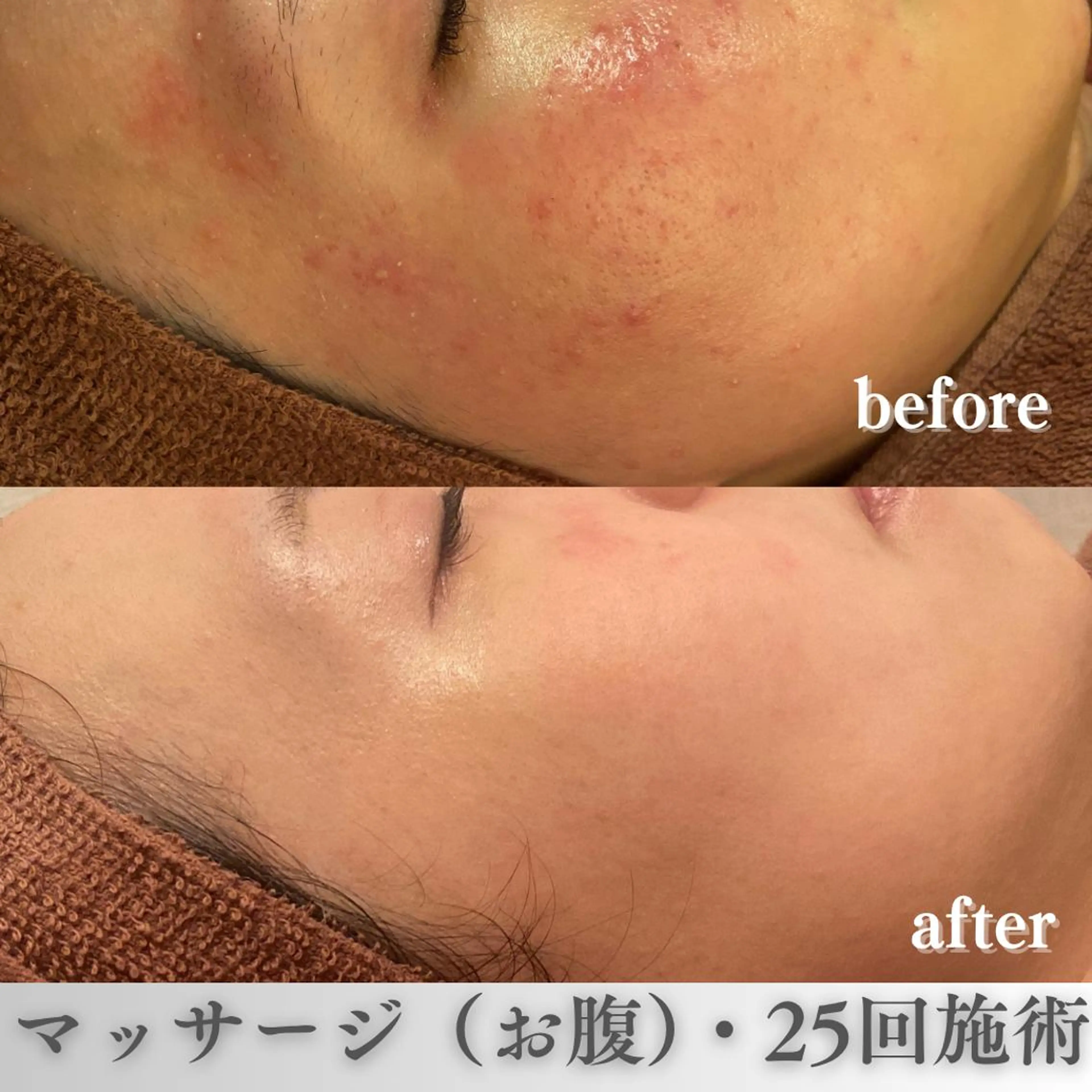 学生ニキビ改善🍀 優しい肌質改善のエステ・リラクイメージ