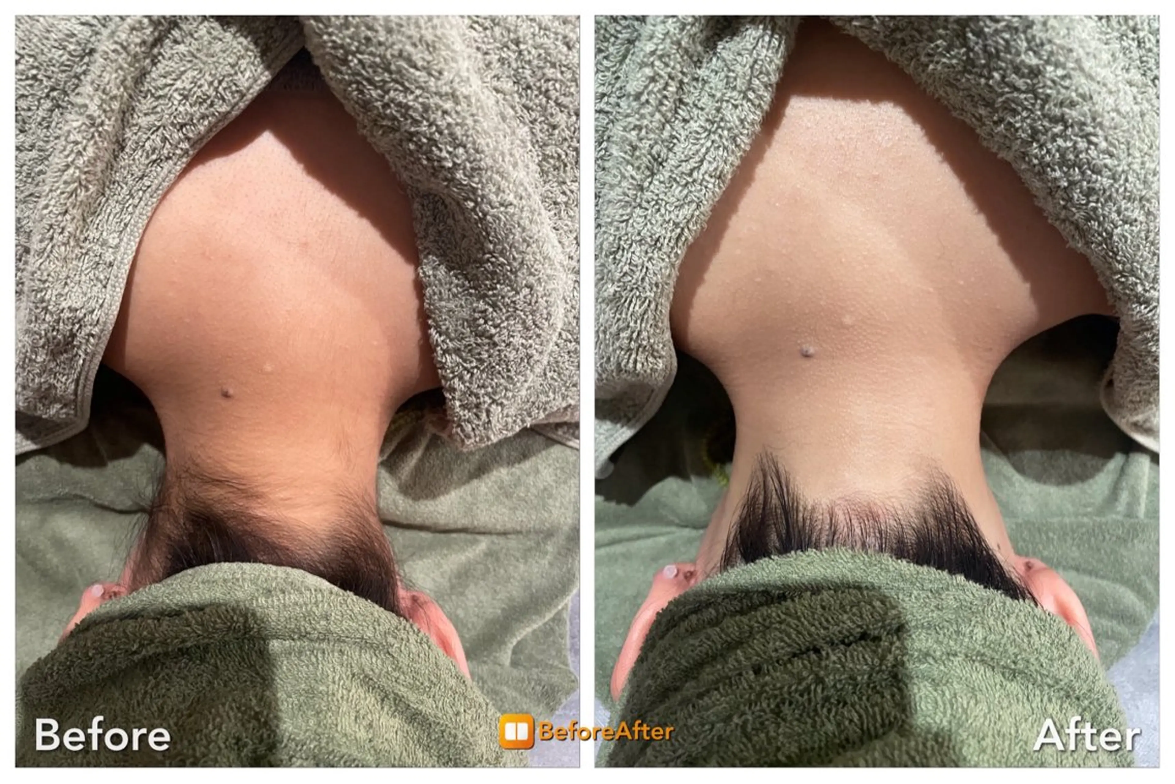 Meupニキビ専門店 背中/ハーブ/肌管理のその他イメージ