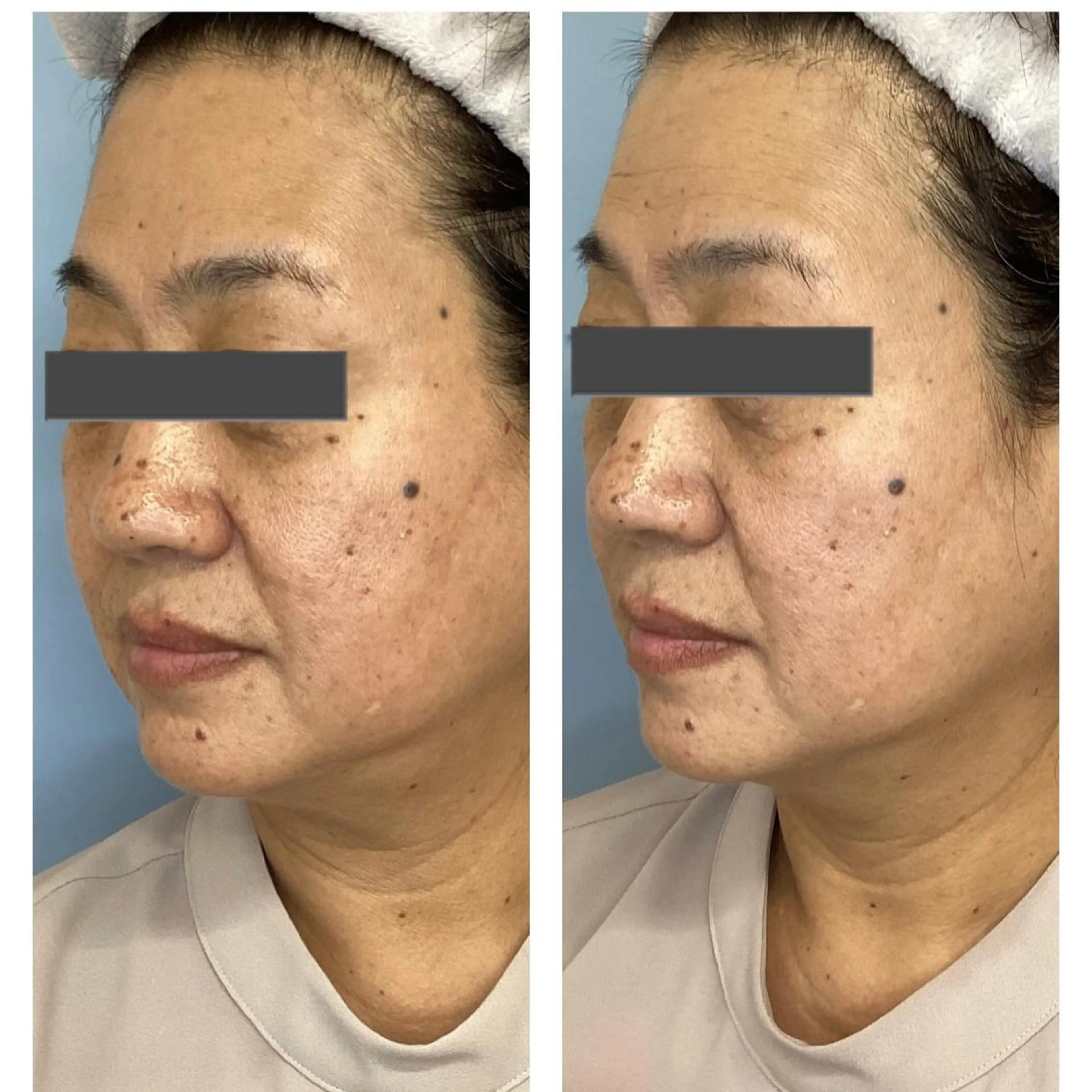 平日minimo限定⭐️むくみ、くすみ改善コースの写真