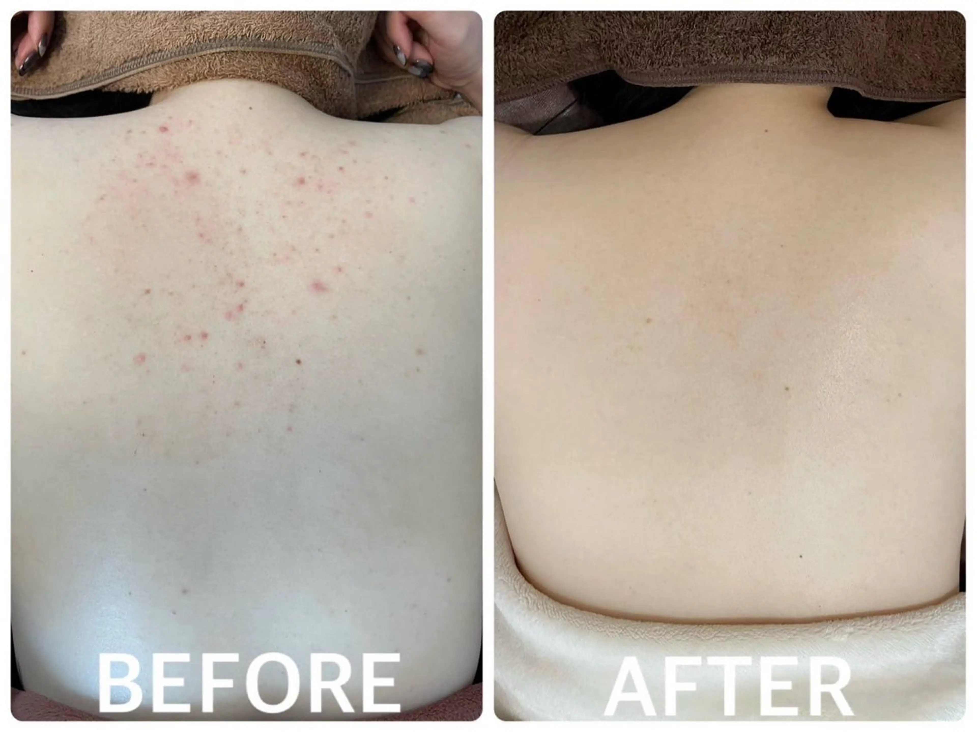 ハーブピーリング 🌿京橋のエステ・リラクイメージ