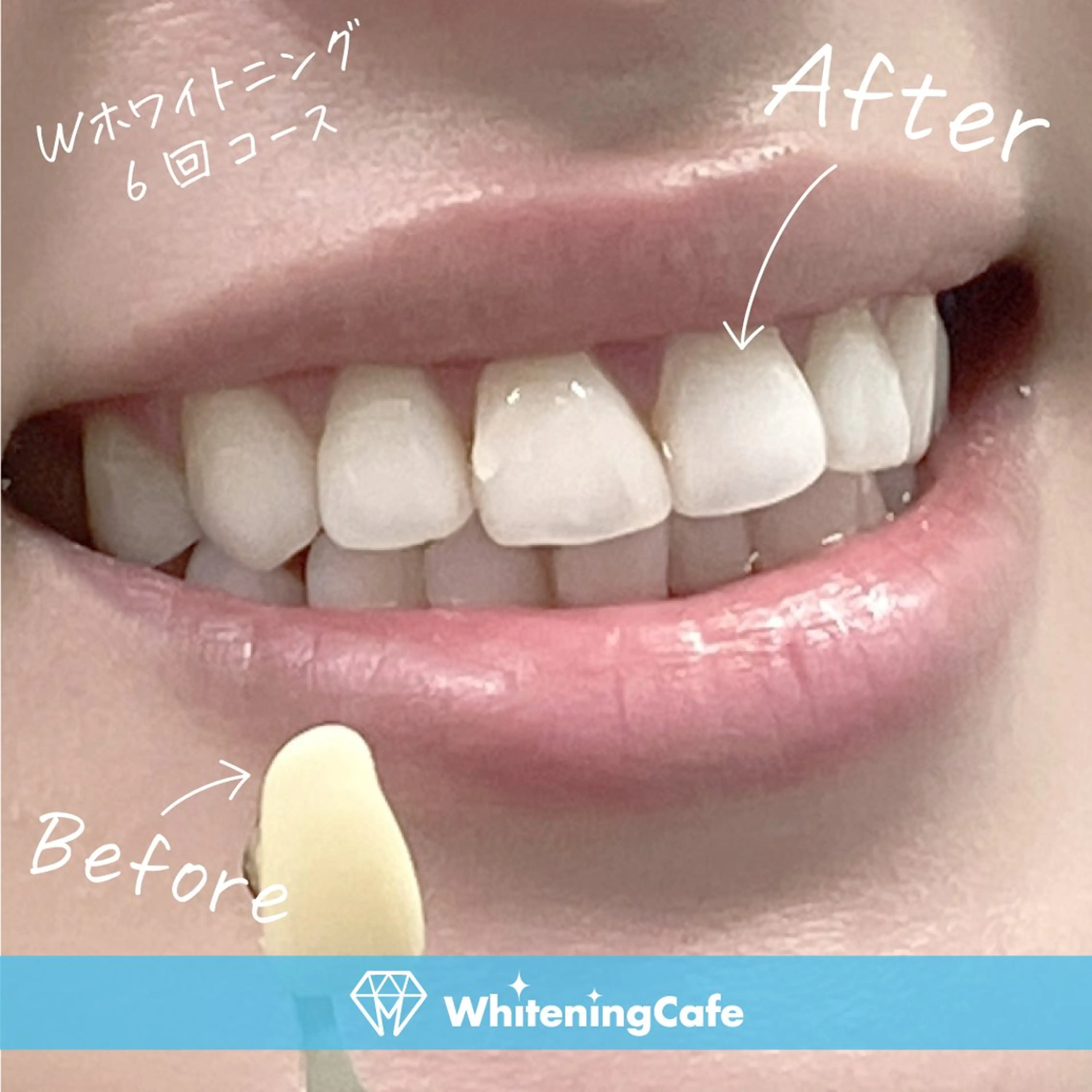 【お試し◇セルフホワイトニング回数券】4回コース+1回分セルフホワイトニングプレゼントの写真