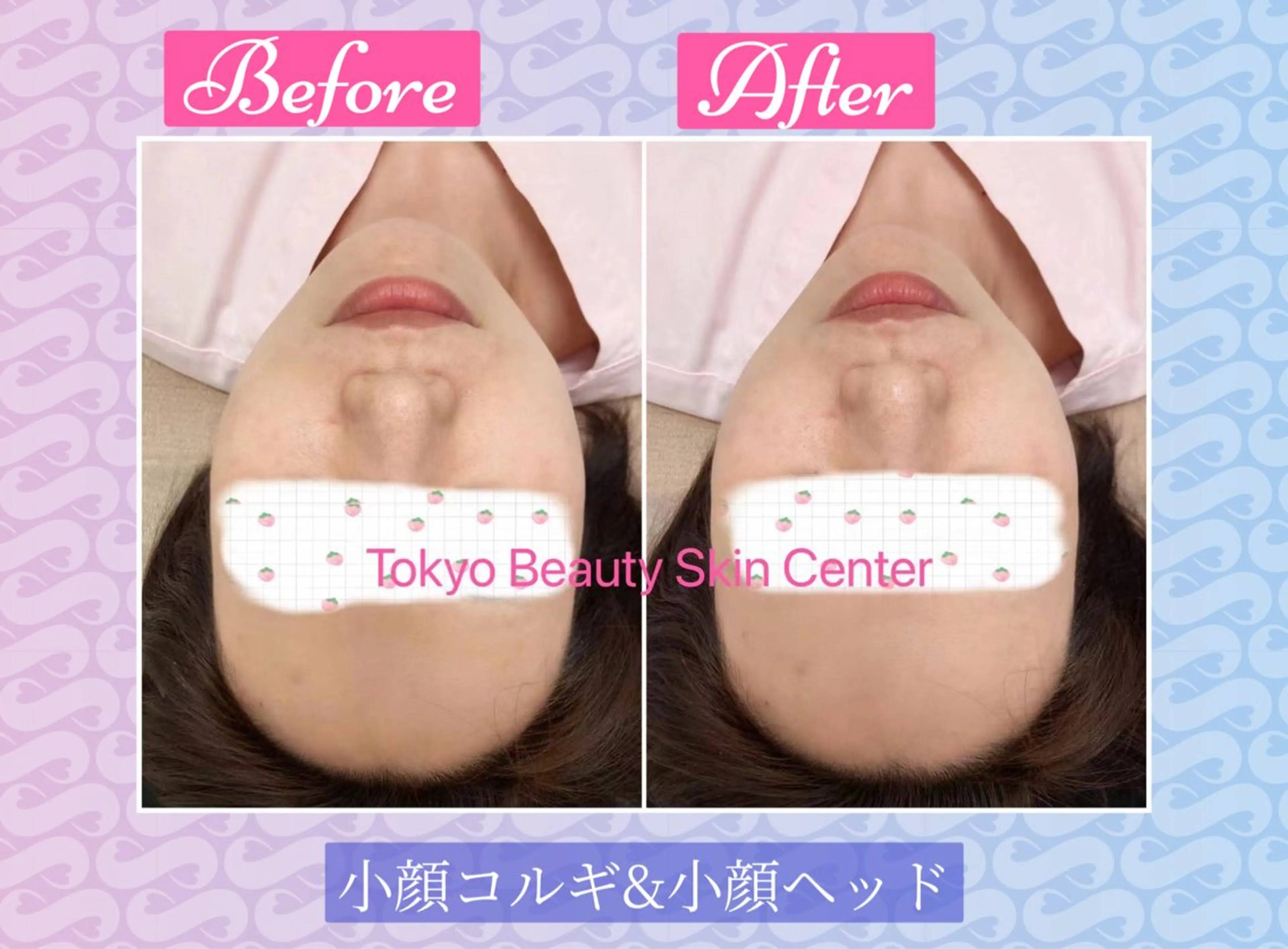 エステ リラク 毛穴洗浄& 睫毛パーマ上野御徒町のマツエク・マツパデザイン