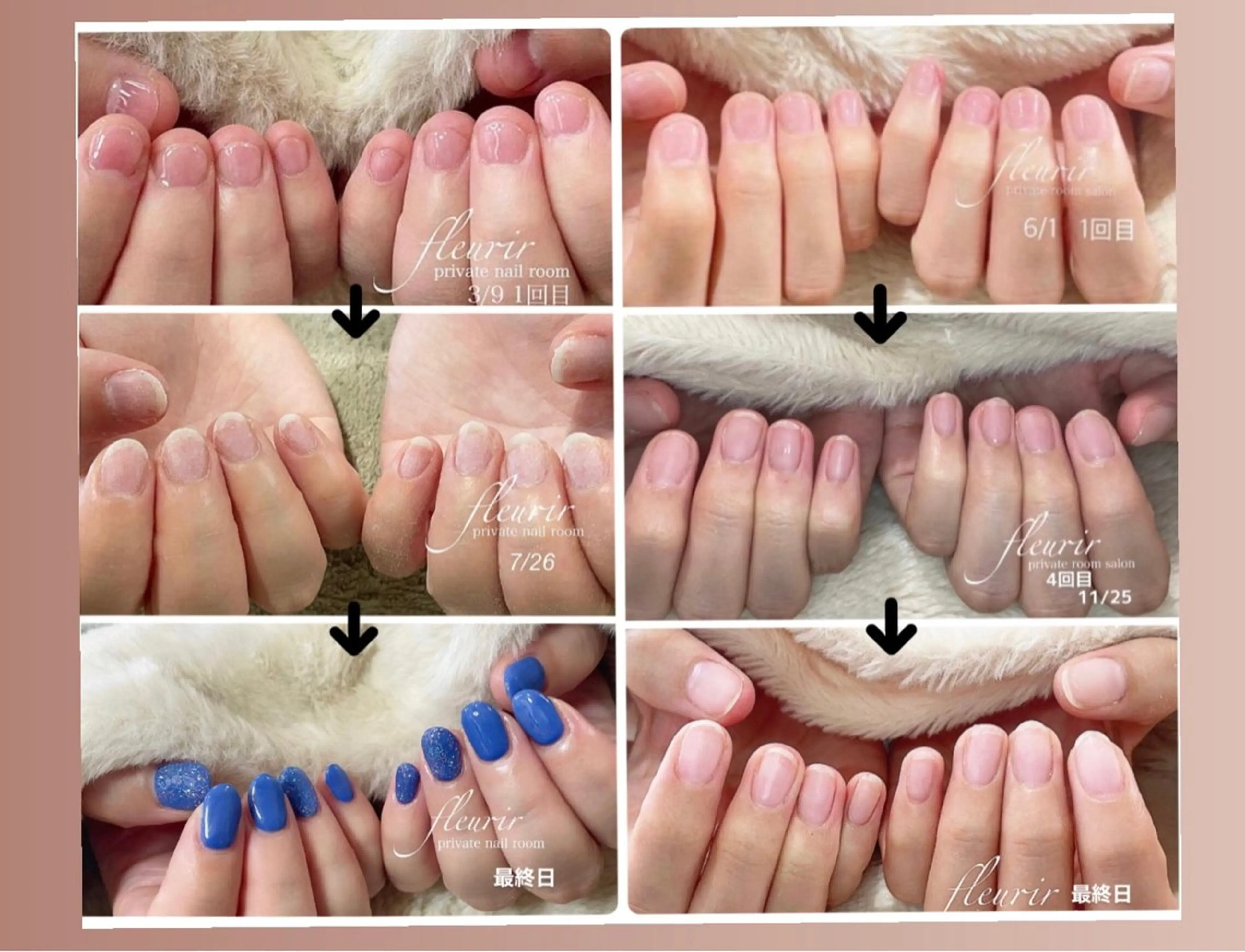 [コンプレックス脱却応援！深爪対策]⚠️噛みグセ イジり癖のある方のみ専用！ 深爪対策についてへの 返信必須です。の写真