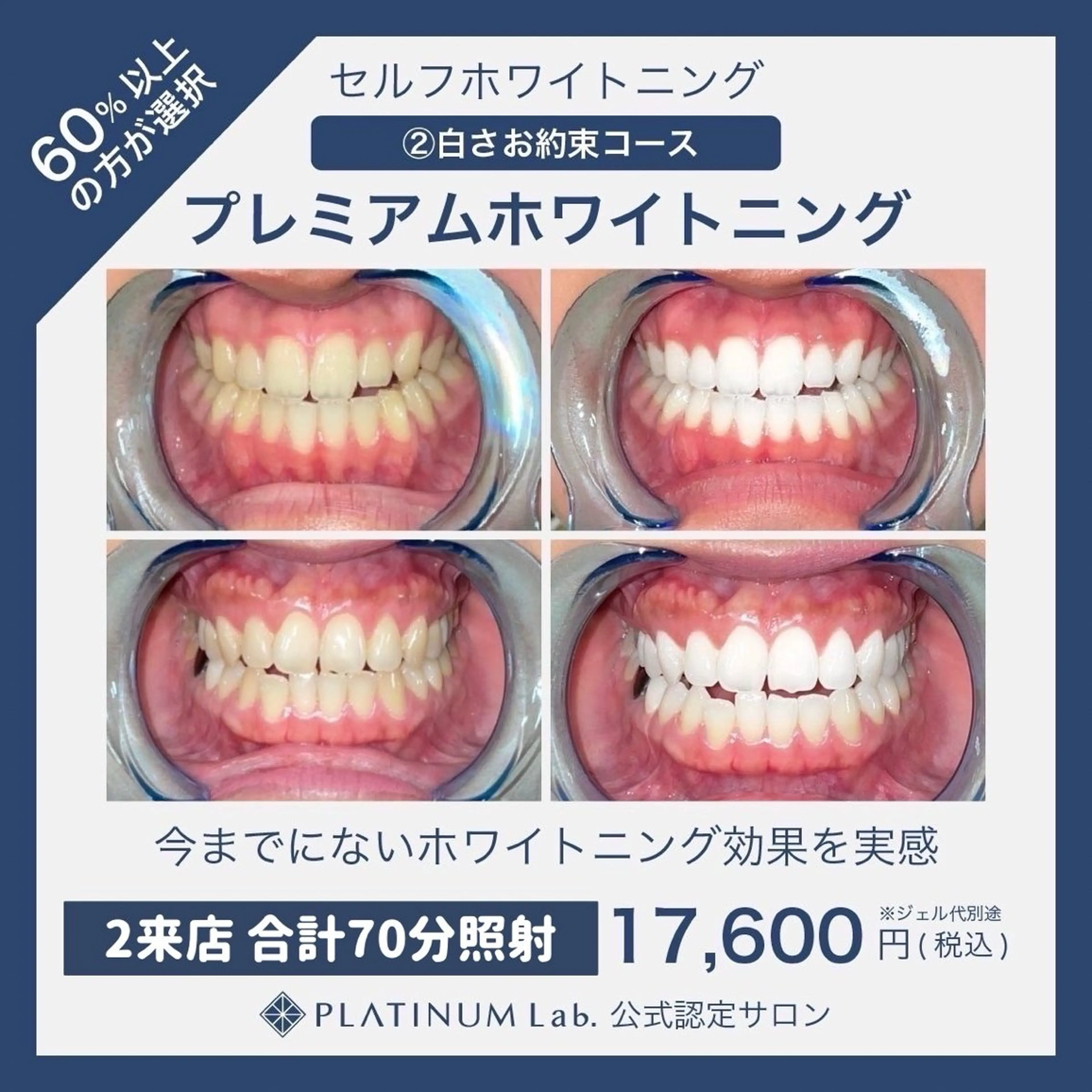 【白さお約束】平均6トーンUP✨️ プレミアムセルフホワイトニング(計70分照射)メンズ歓迎👨の写真
