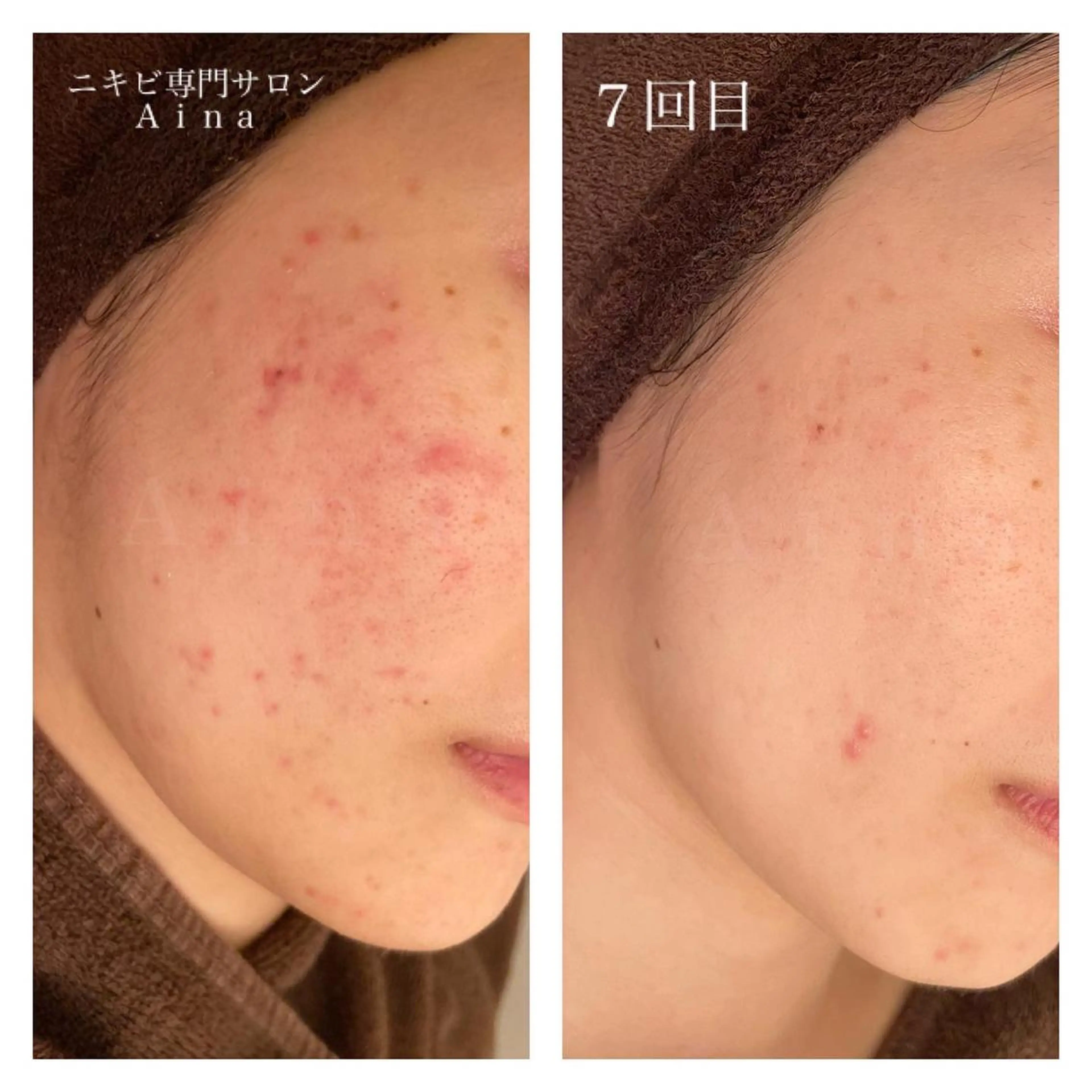 ロング カラー パーマ ヘアアレンジ メンズ キッズ ネイル マツエク・マツパ 卒業式のヘアスタイル 卒業式 赤色 ニキビ跡専門サロン Ainaのエステ・リラクイメージ